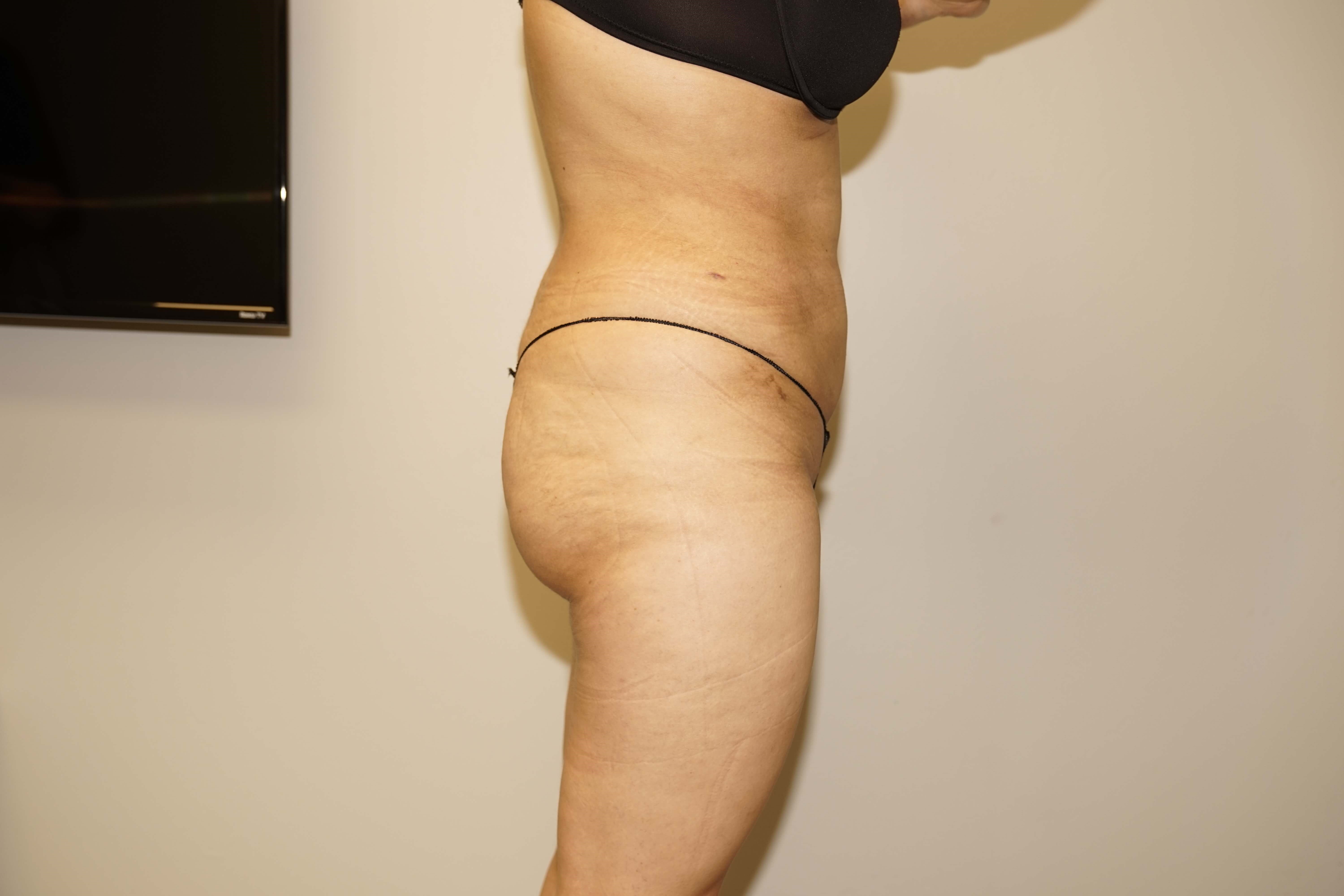 Woman has BBL Butt Lift After