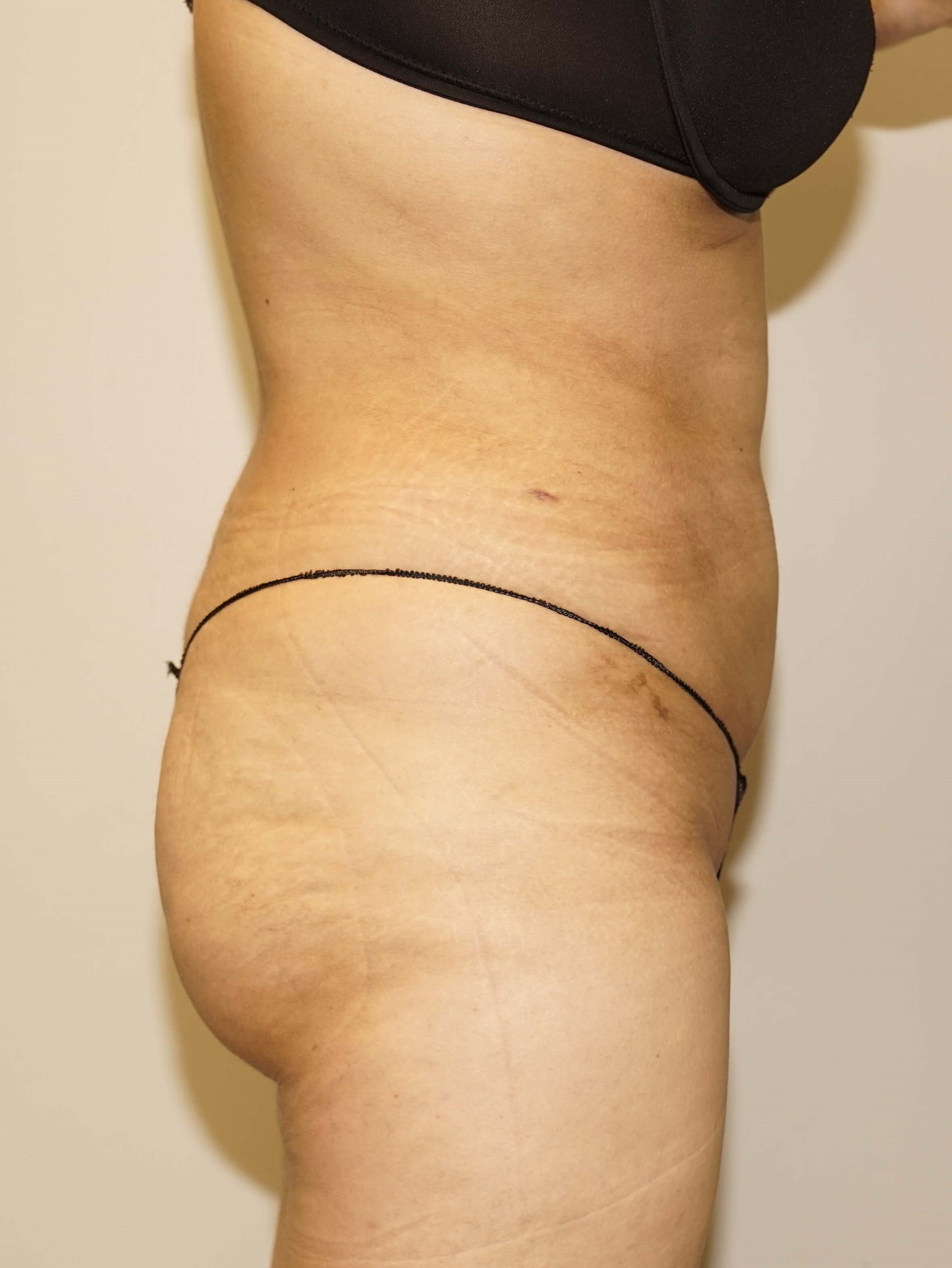 Woman has BBL Butt Lift After