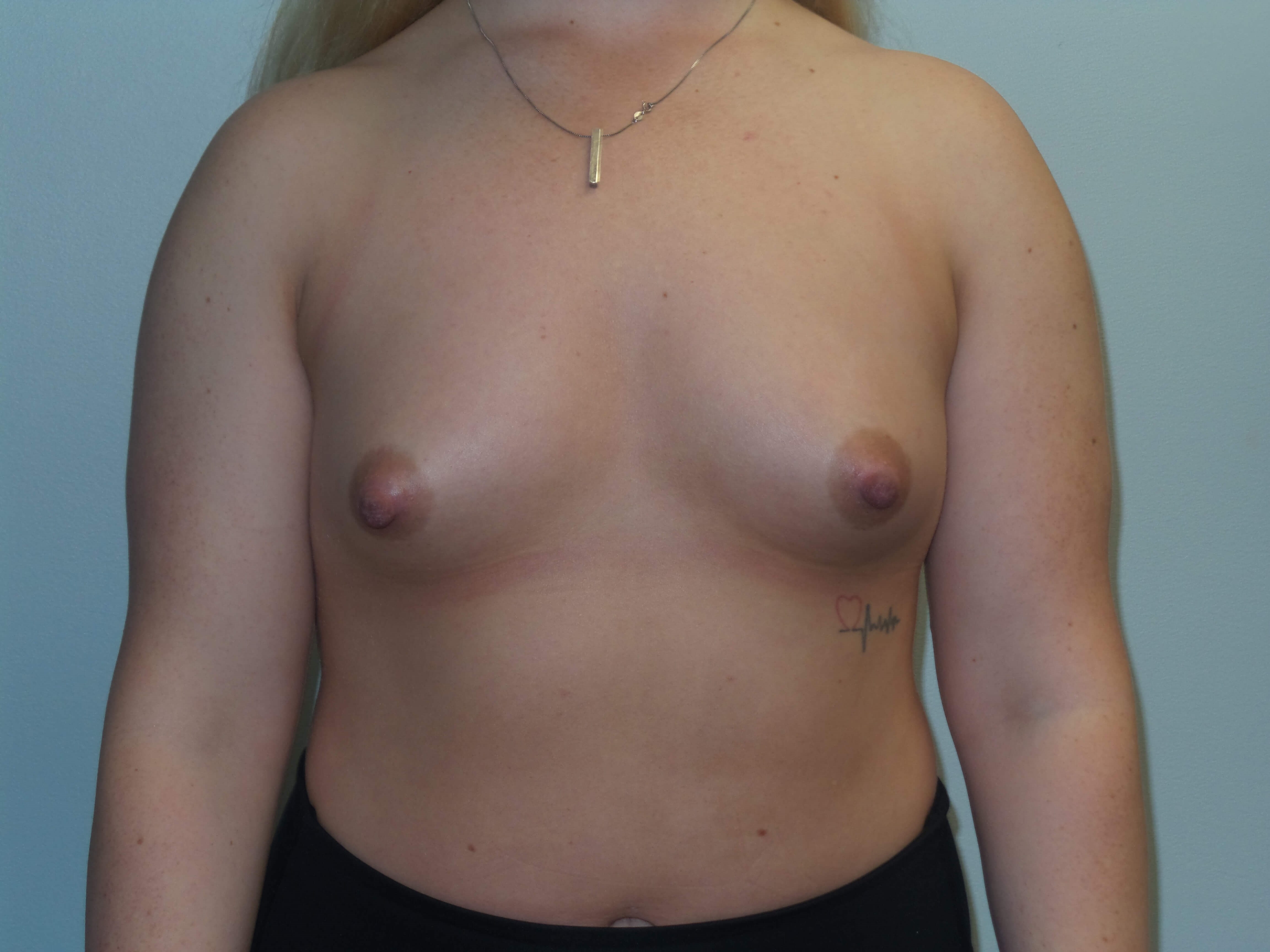 Westlake Woman Has Breast Aug Before