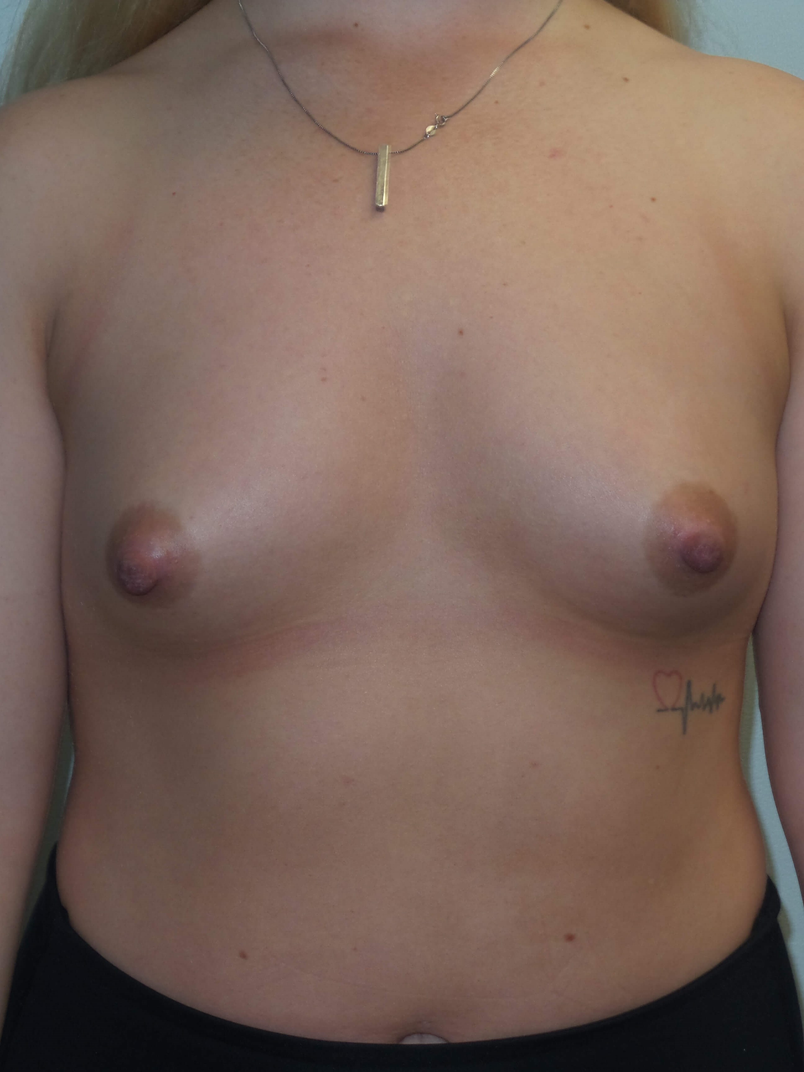 Westlake Woman Has Breast Aug Before