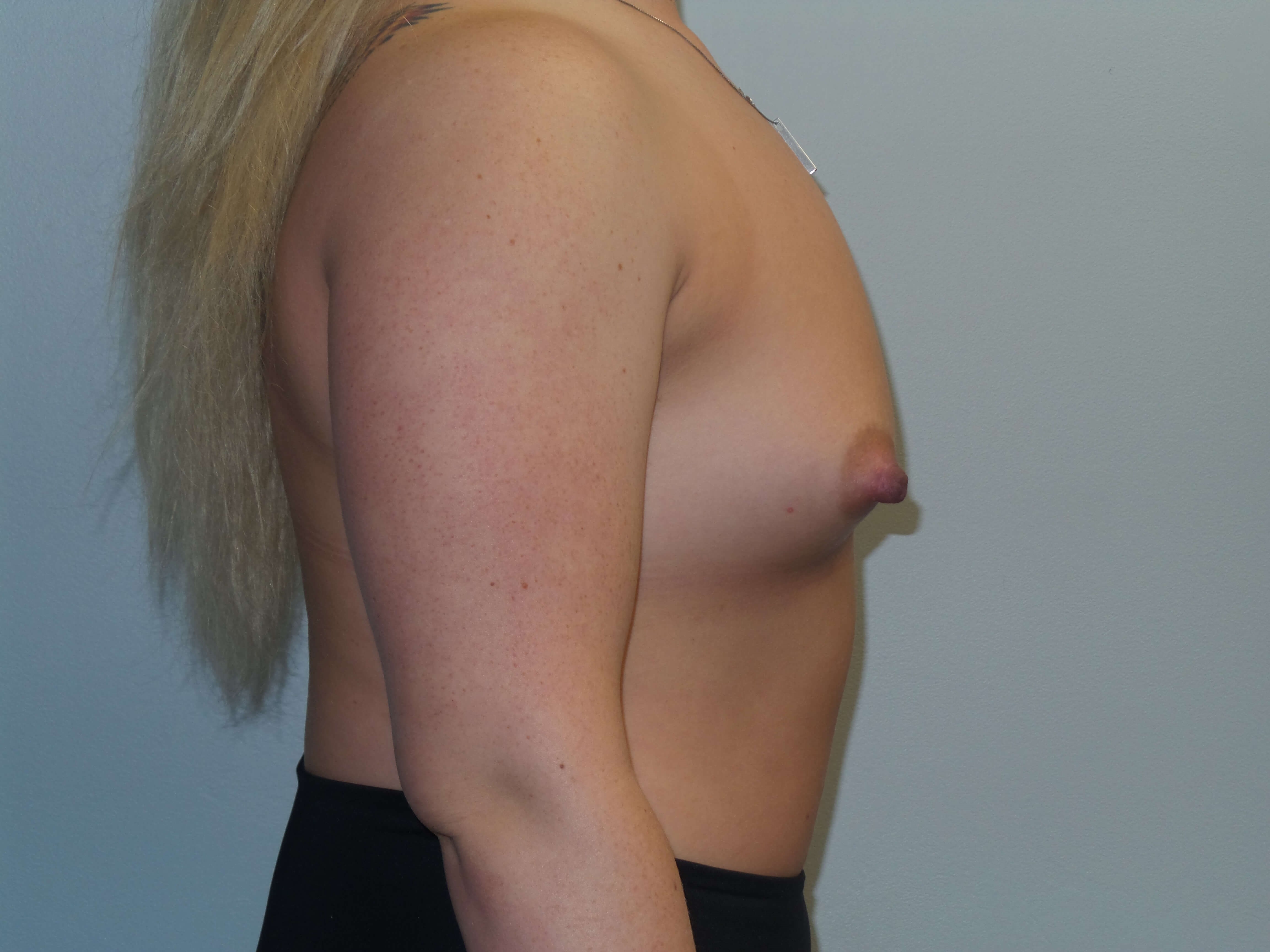 Westlake Woman Has Breast Aug Before