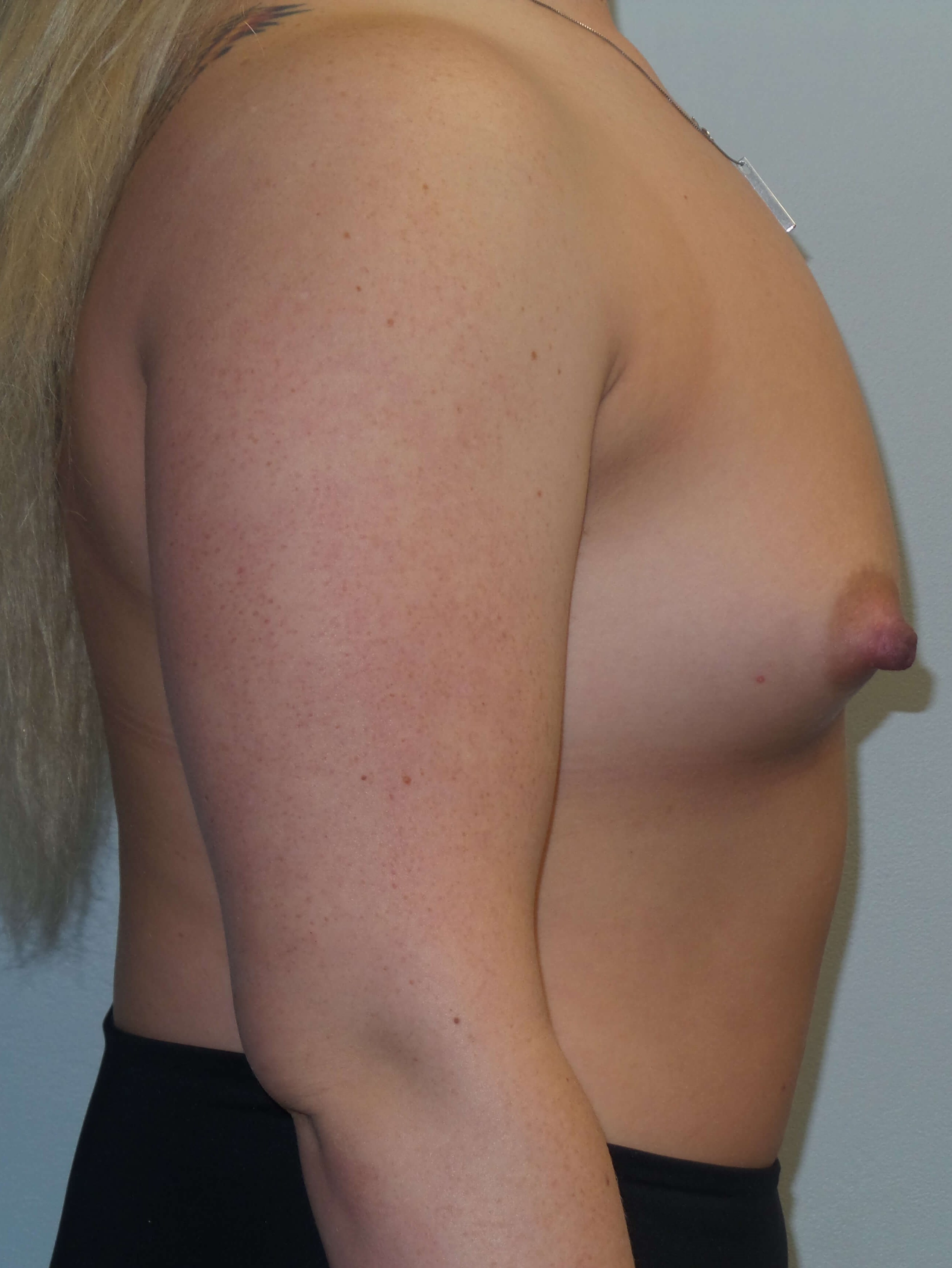 Westlake Woman Has Breast Aug Before