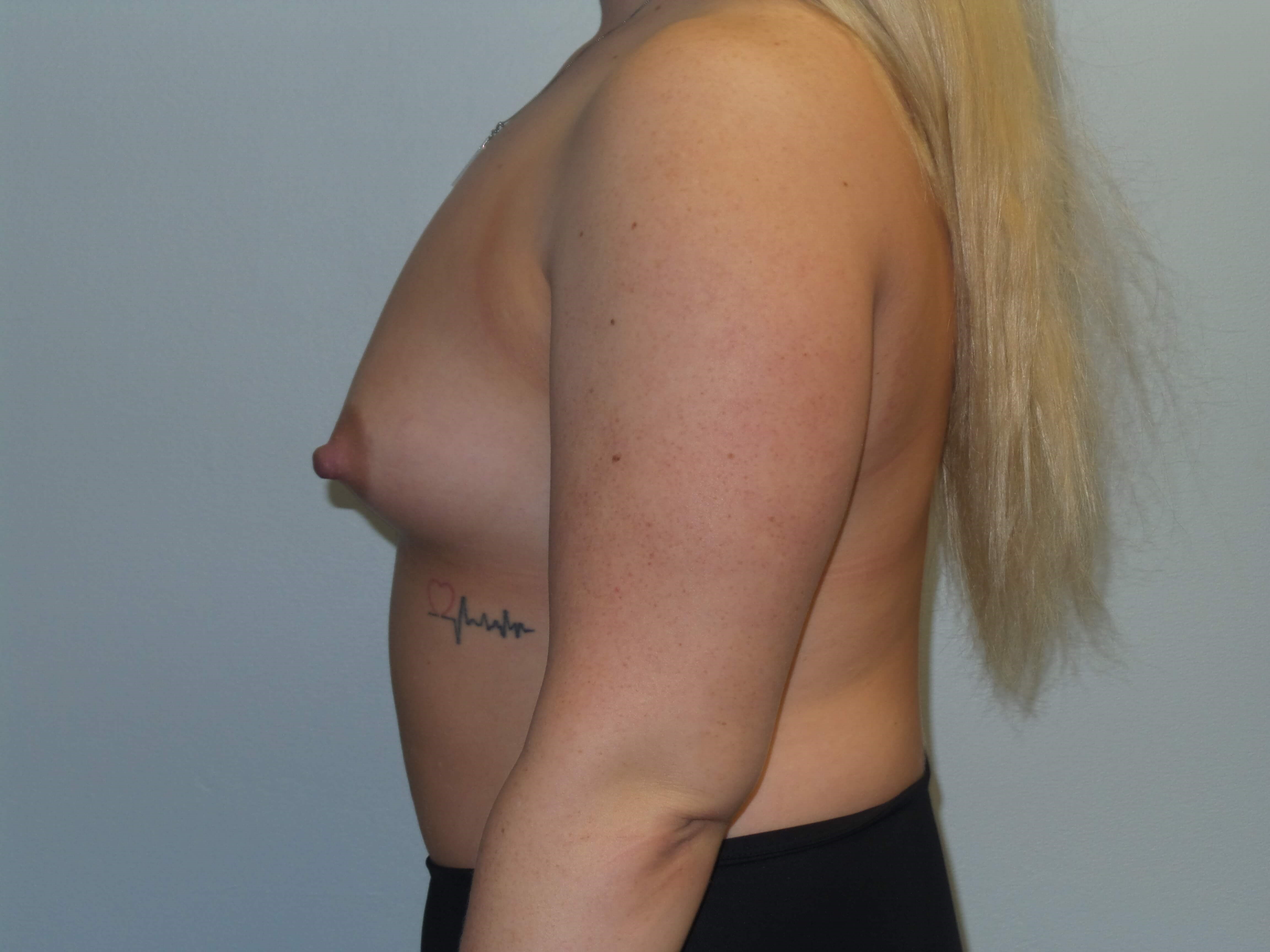 Westlake Woman Has Breast Aug Before