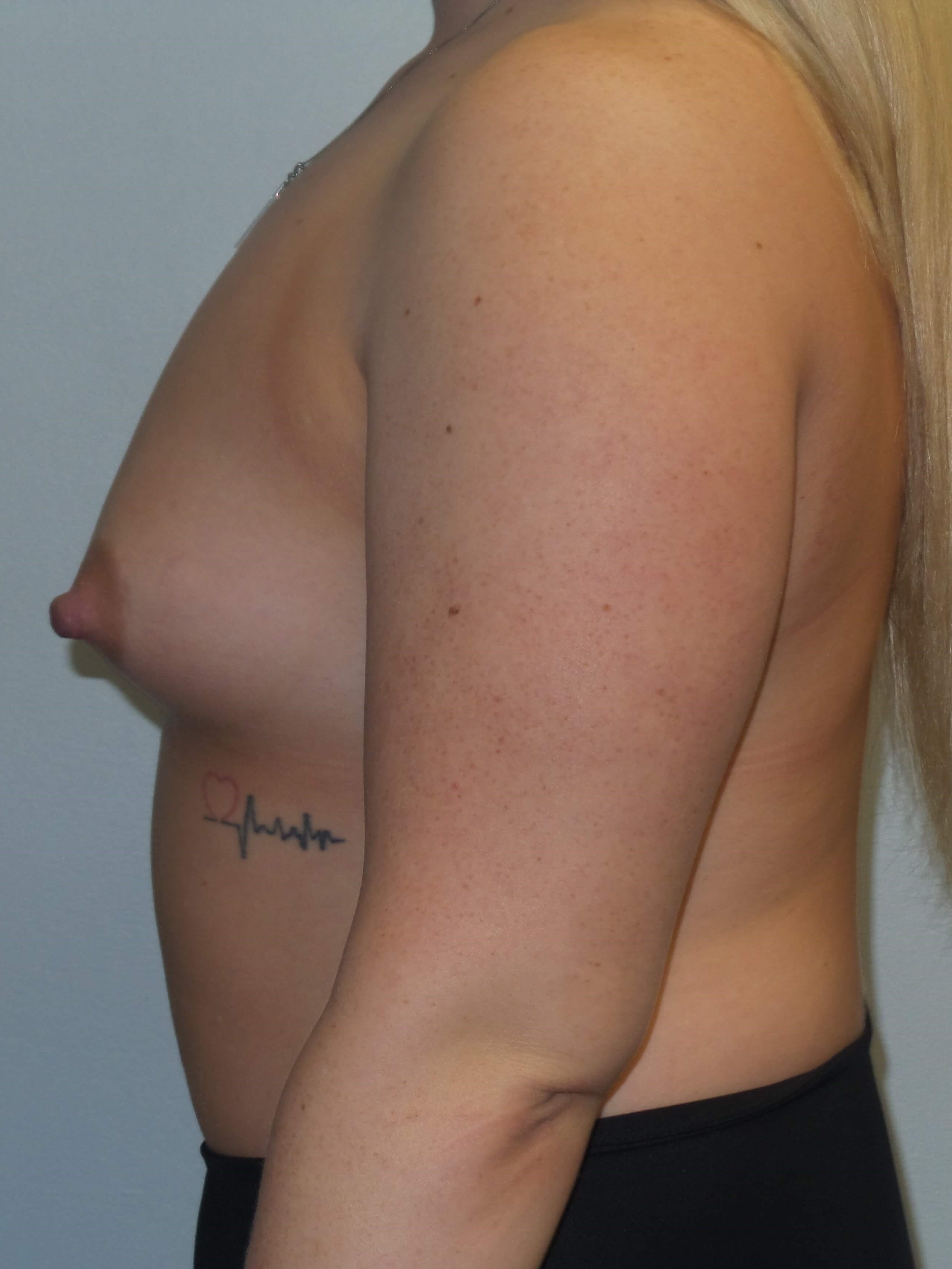 Westlake Woman Has Breast Aug Before