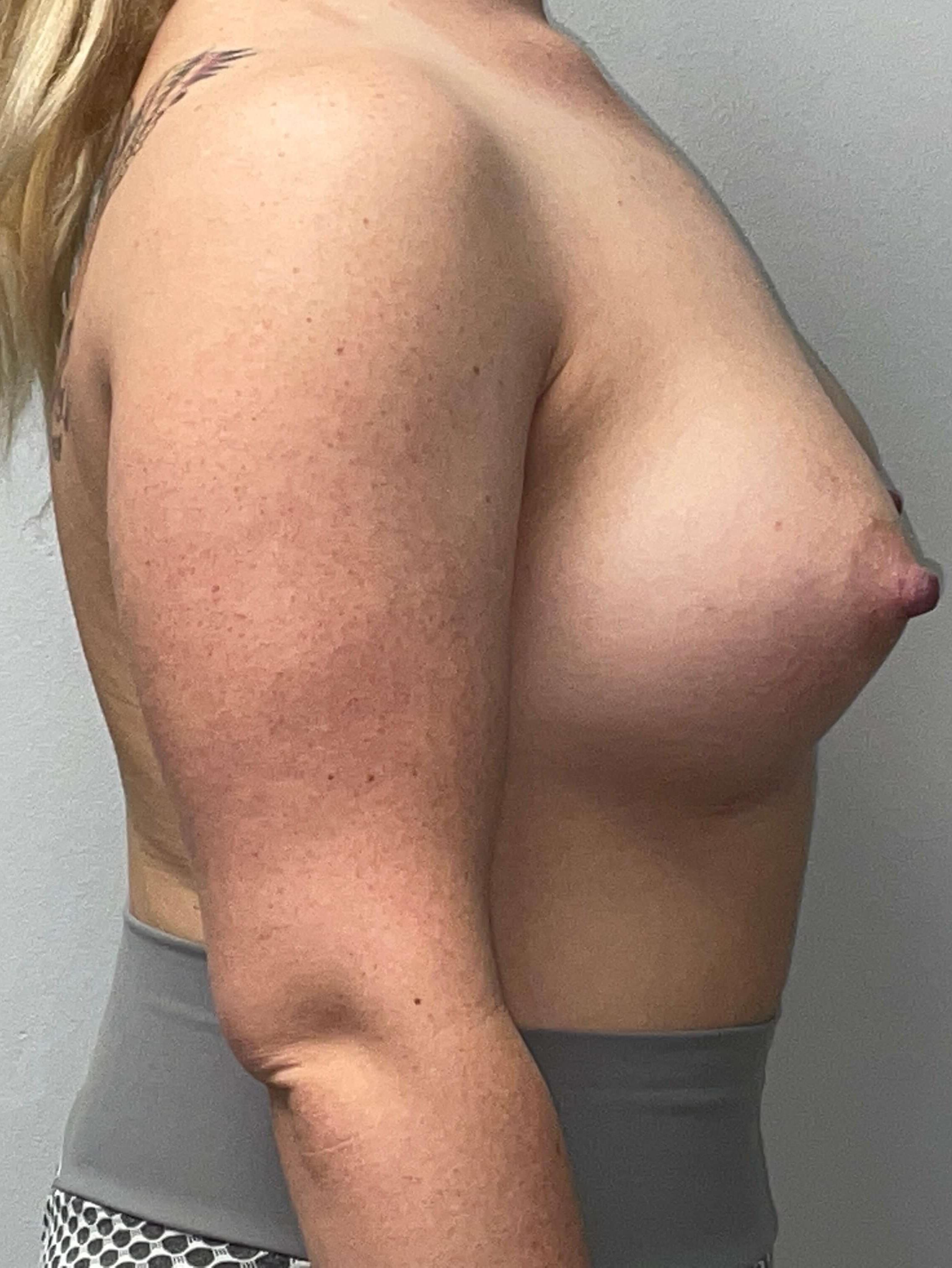Westlake Woman Has Breast Aug After