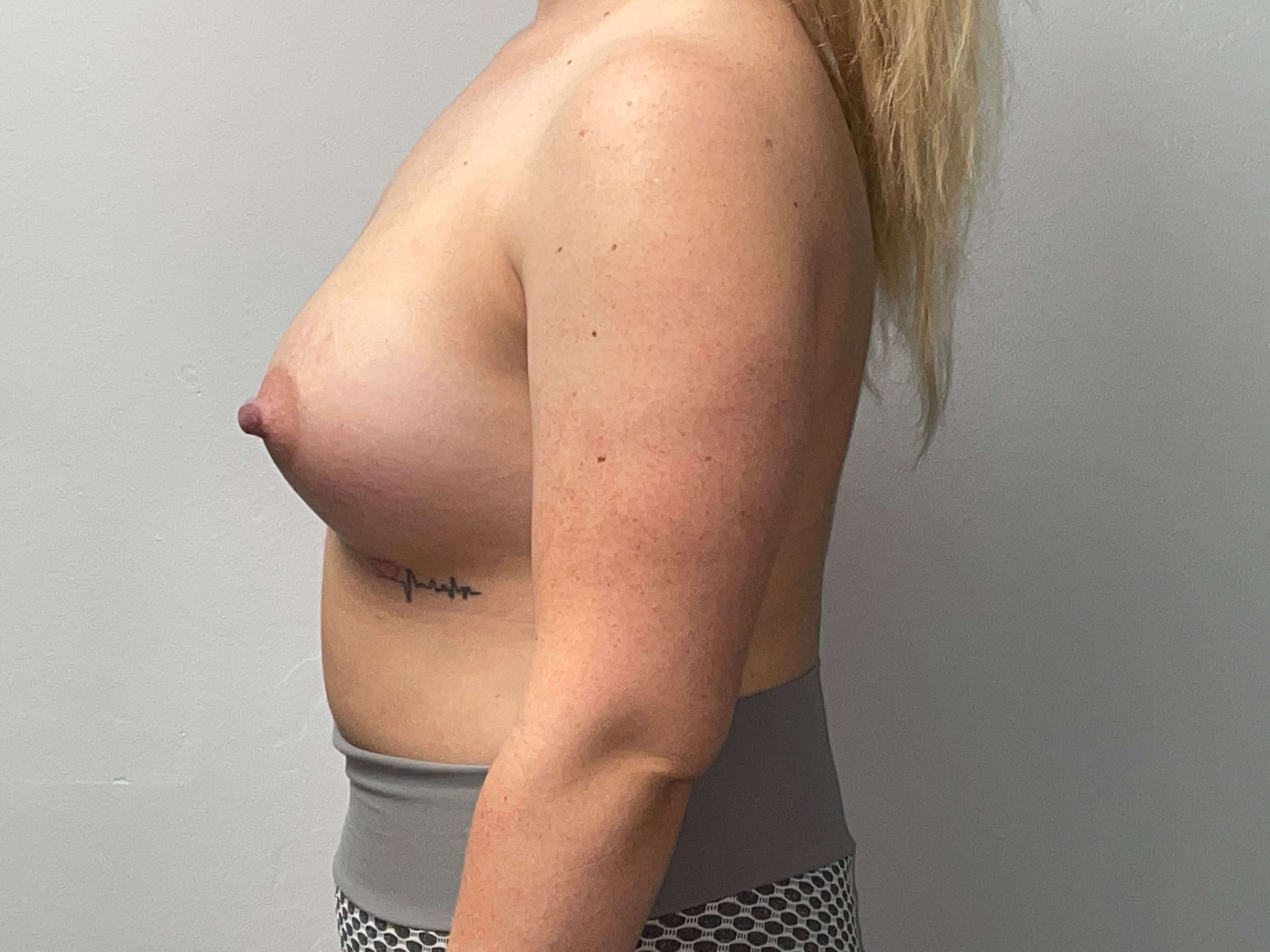 Westlake Woman Has Breast Aug After