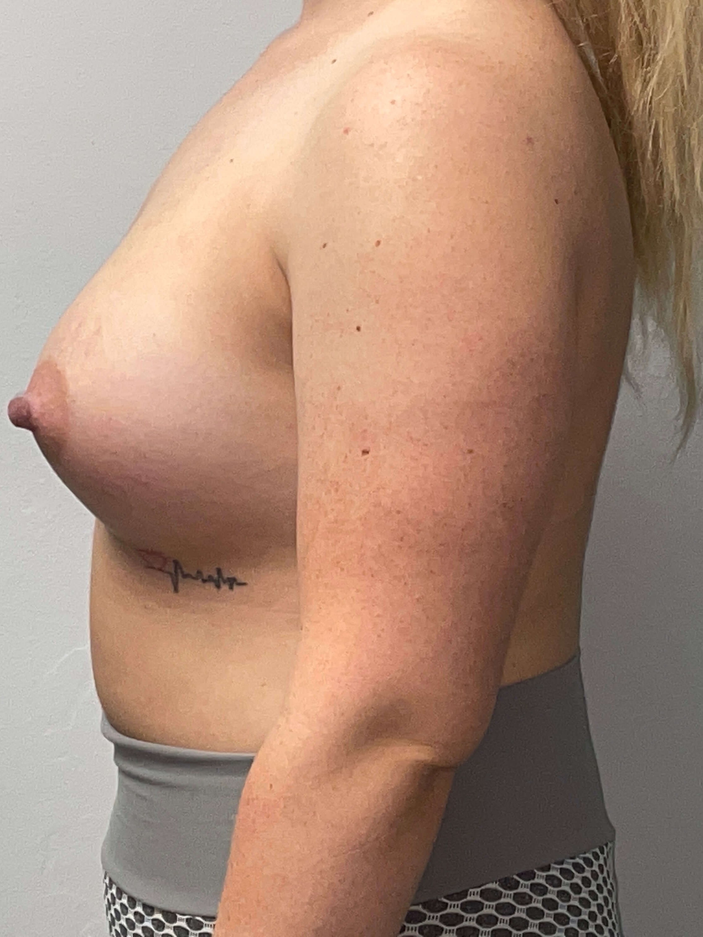 Westlake Woman Has Breast Aug After