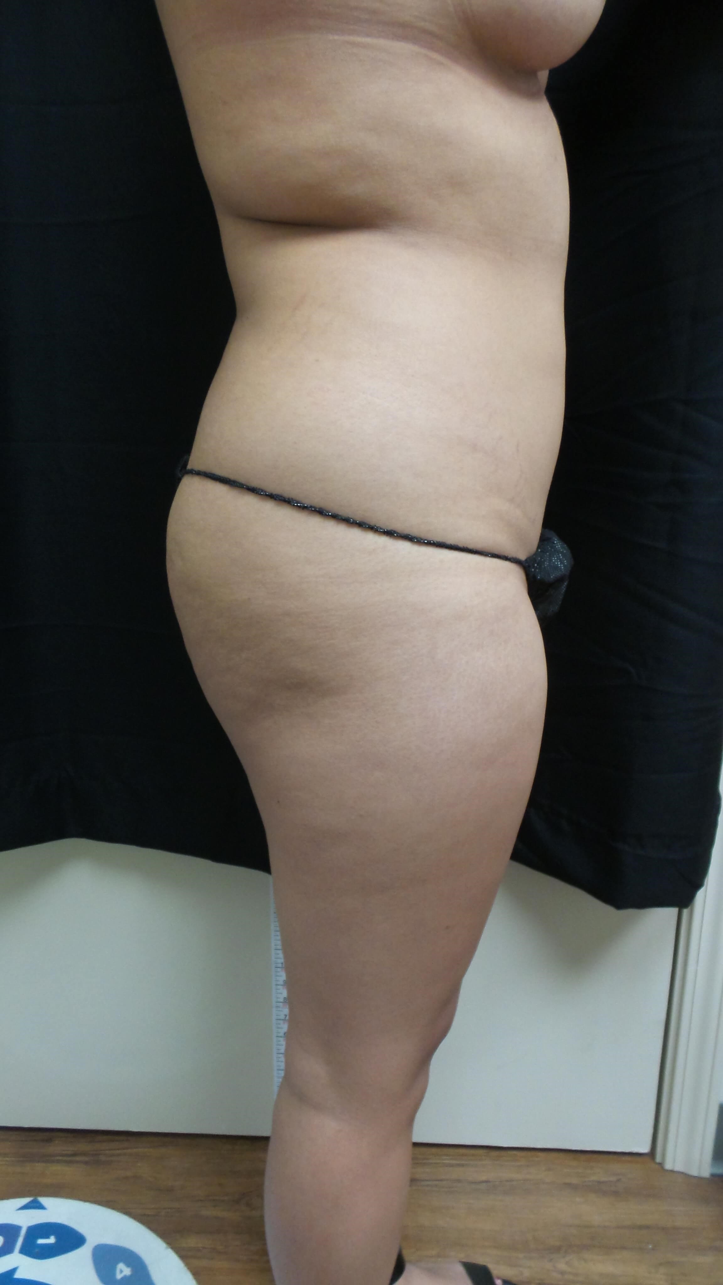 Woman has BBL Butt Lift Before