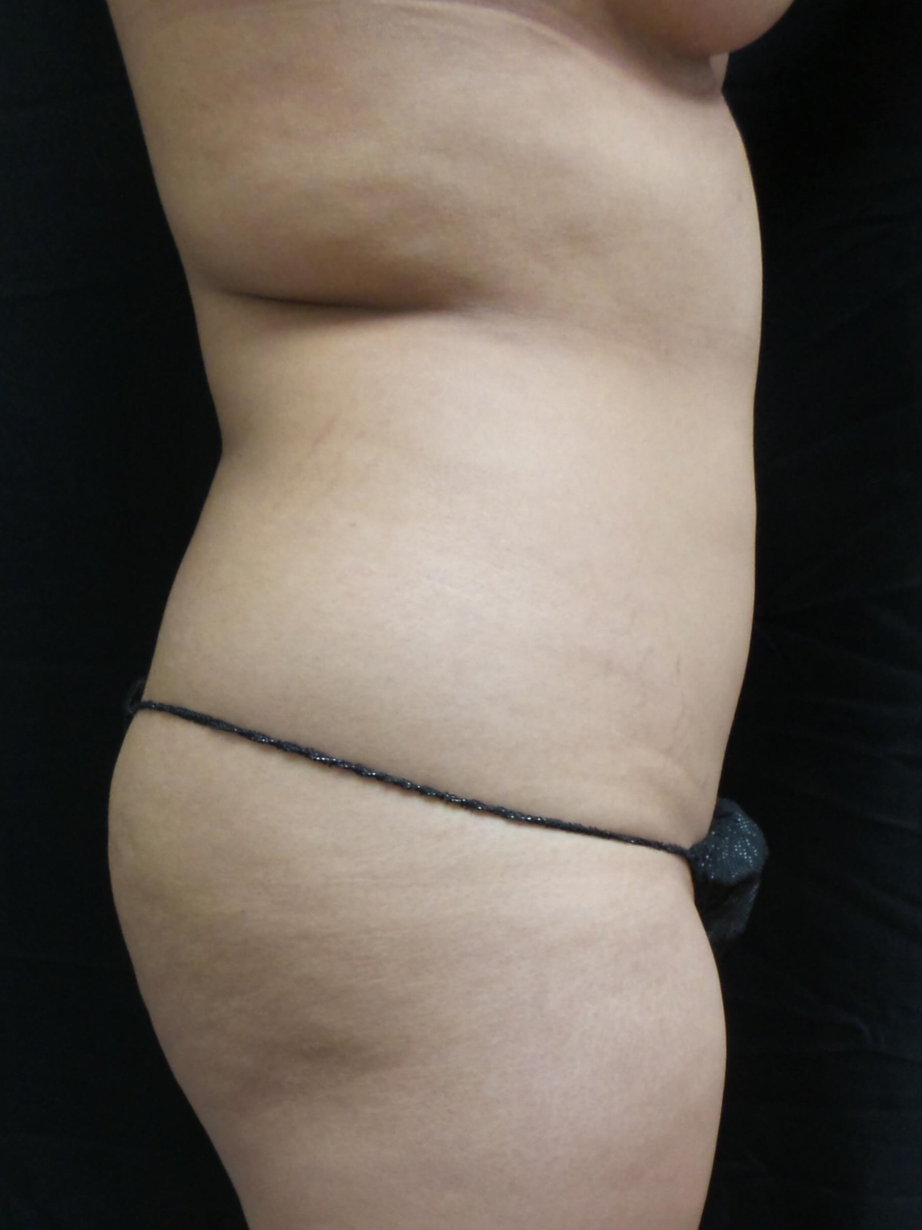 Woman has BBL Butt Lift Before