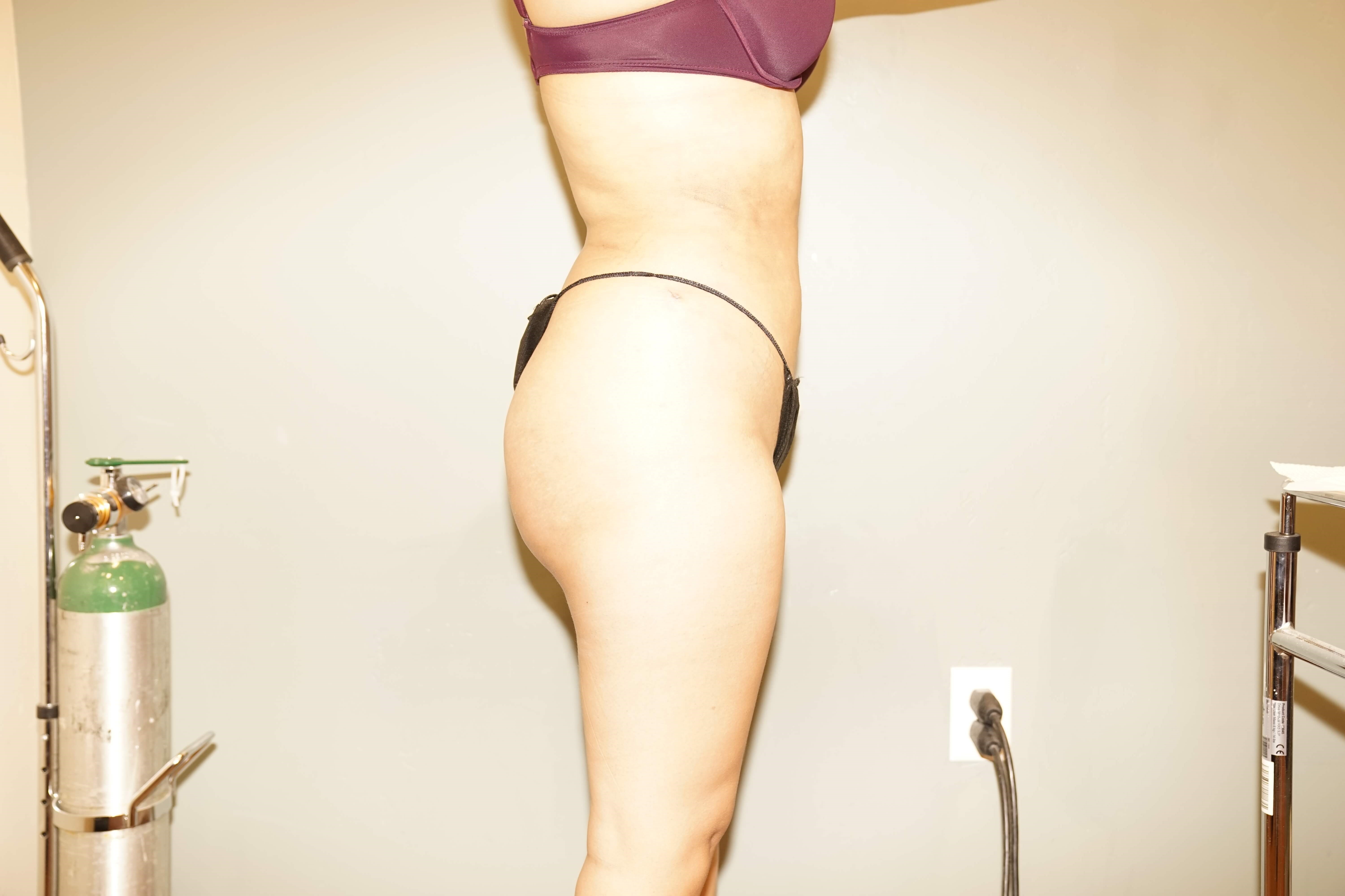Woman has BBL Butt Lift After