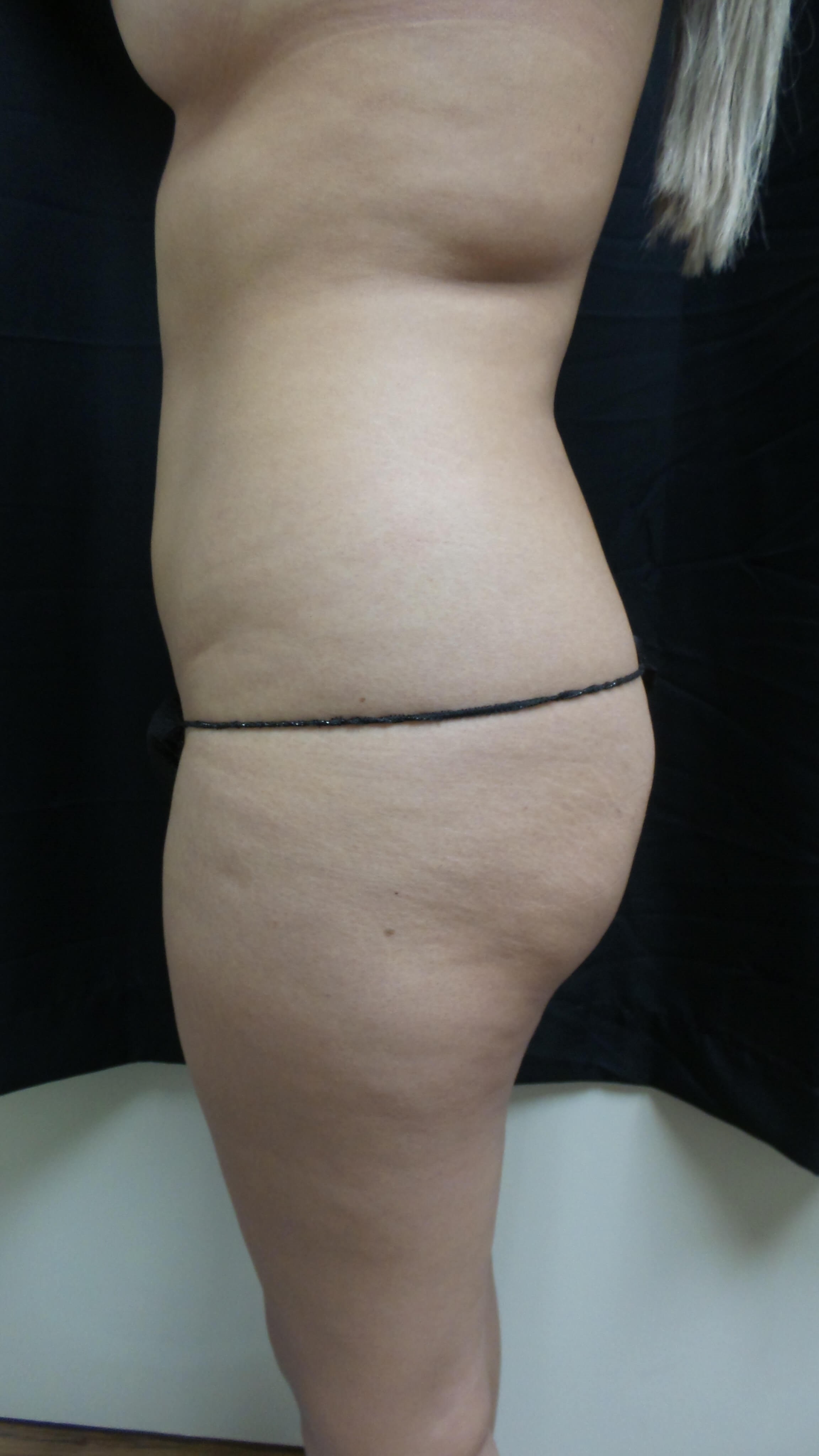 Woman has BBL Butt Lift Before