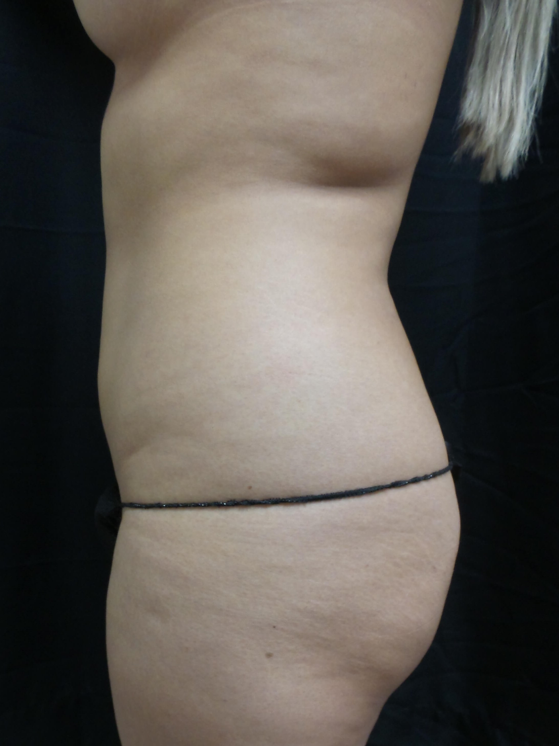 Woman has BBL Butt Lift Before