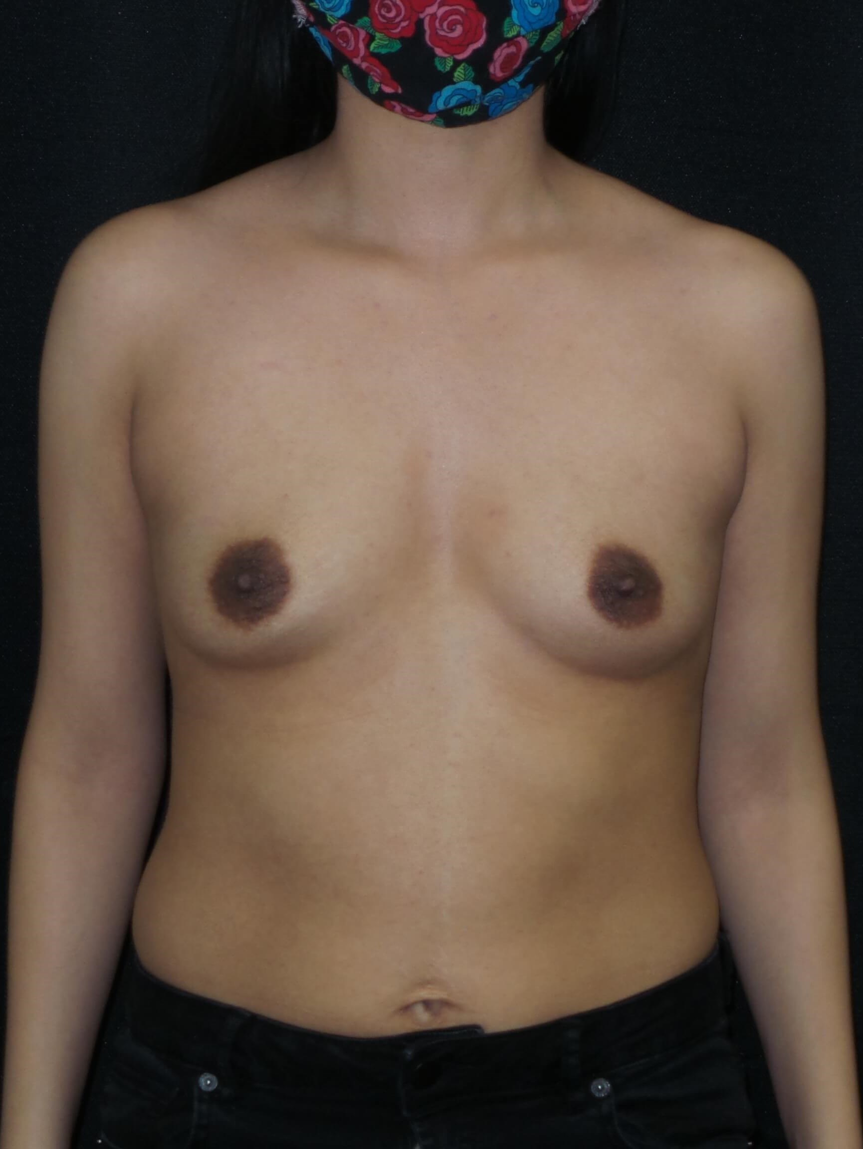 Westlake Woman Has Breast Aug Before