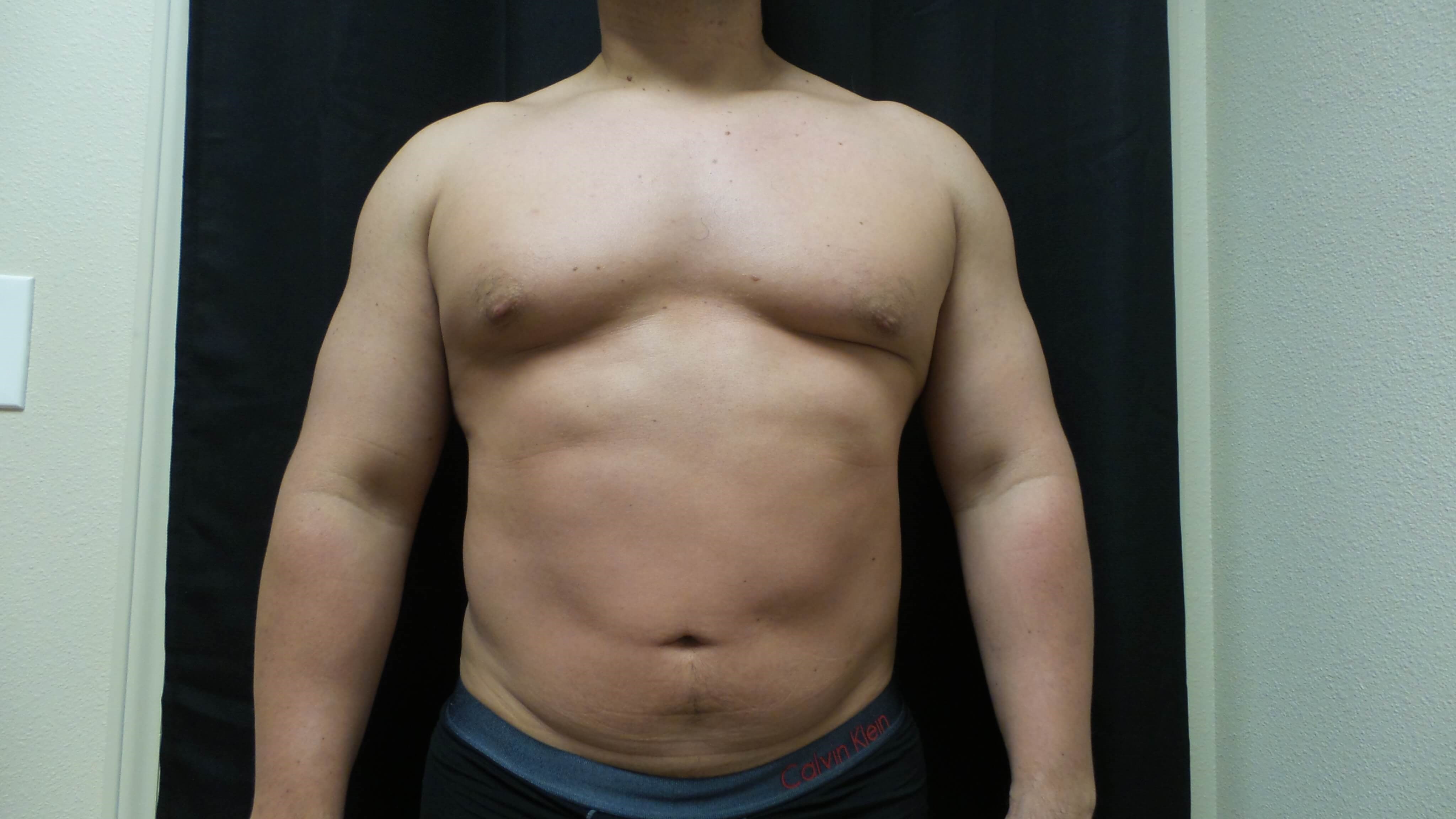 Man has Liposuction Abdomen Before