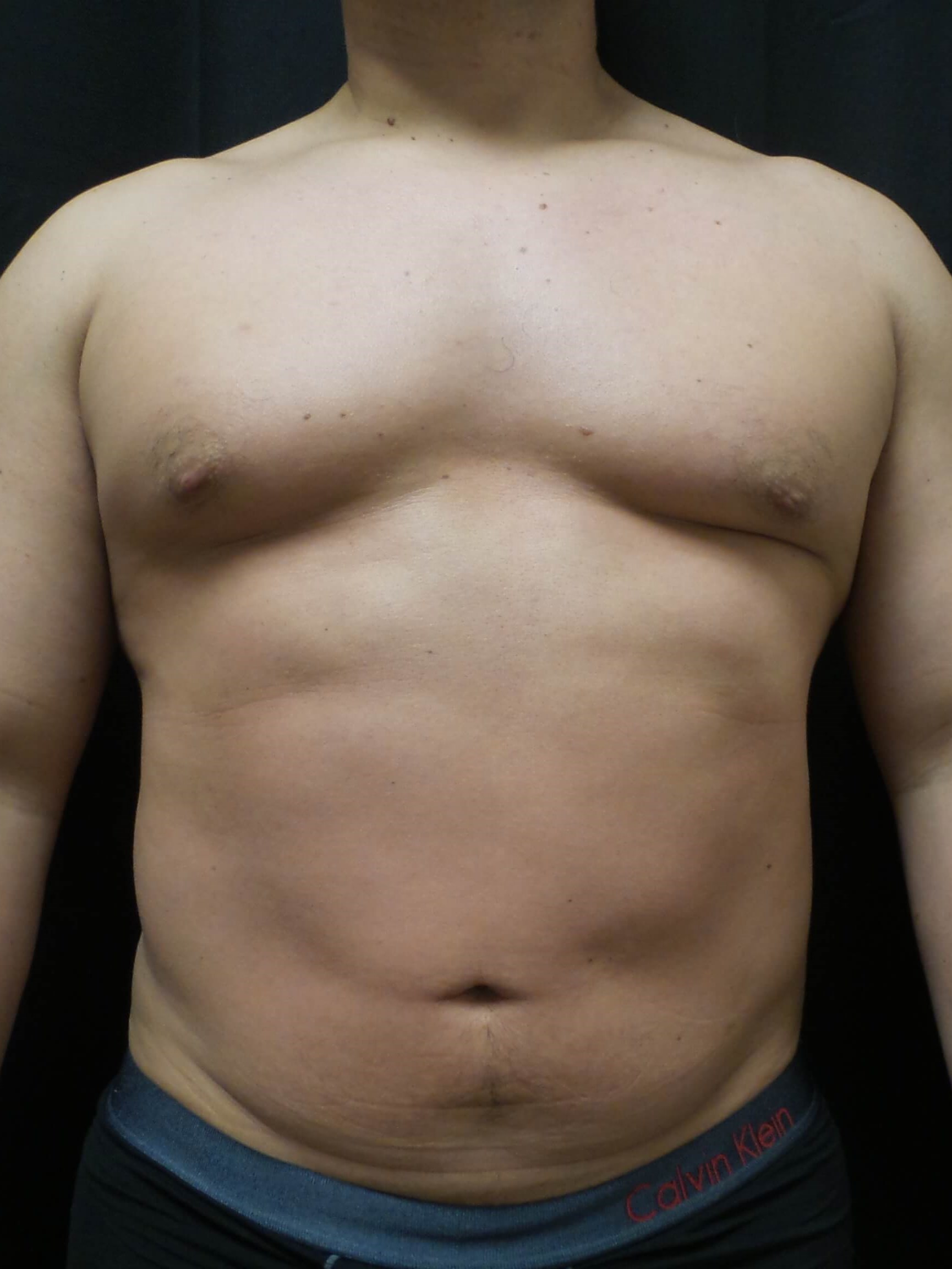 Man has Liposuction Abdomen Before