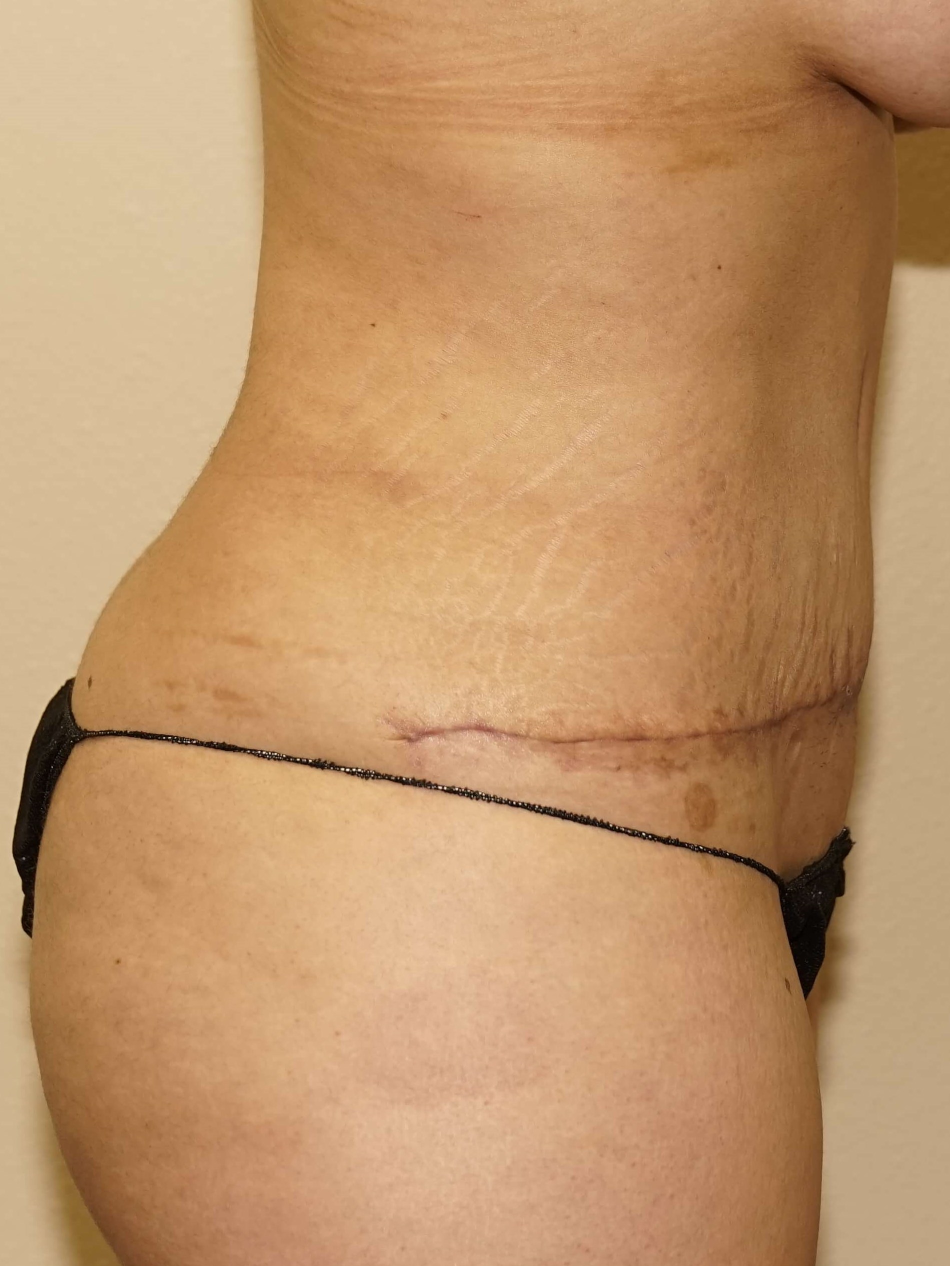 Woman Has Tummy Tuck Lipo After