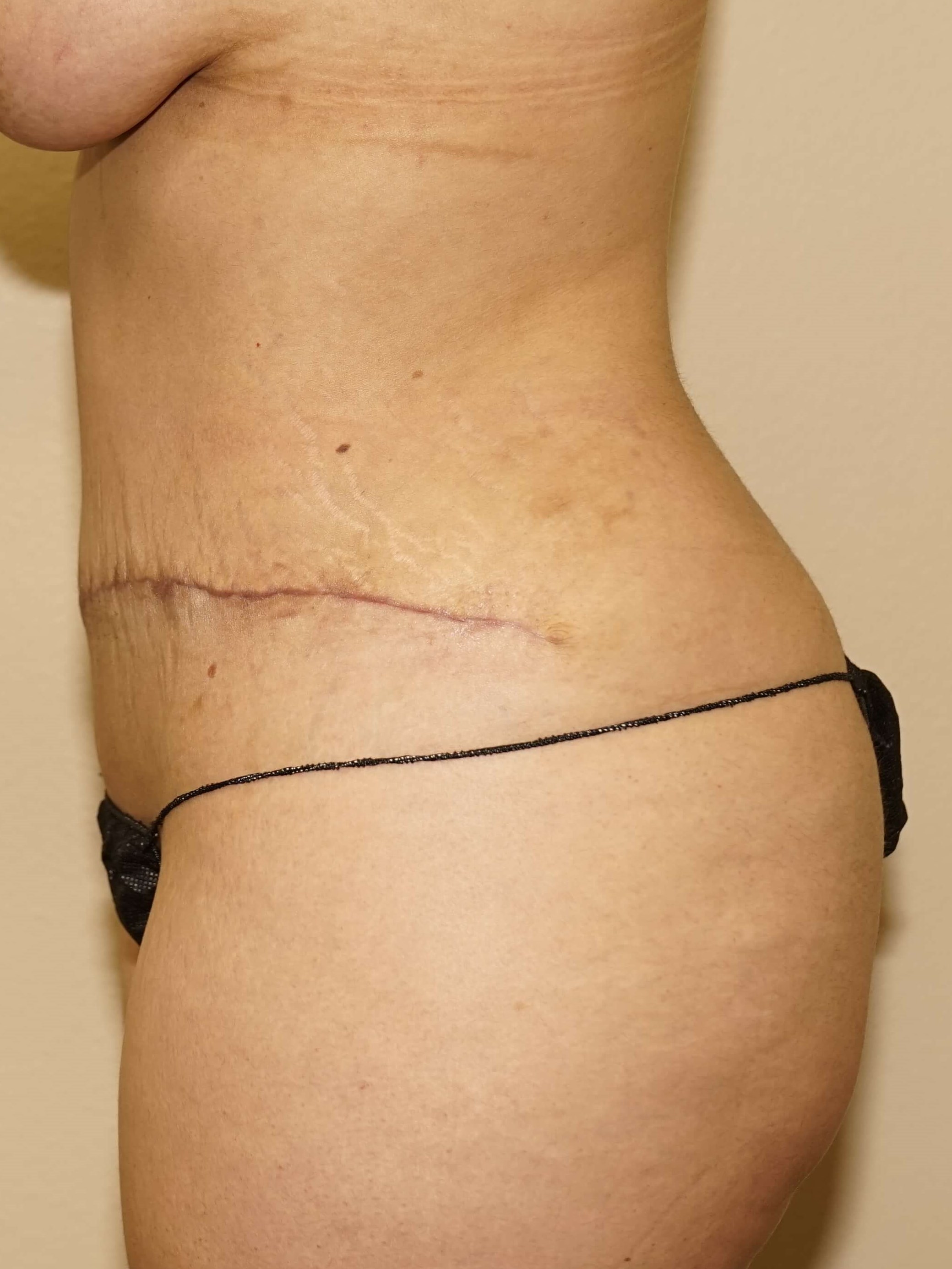 Woman Has Tummy Tuck Lipo After