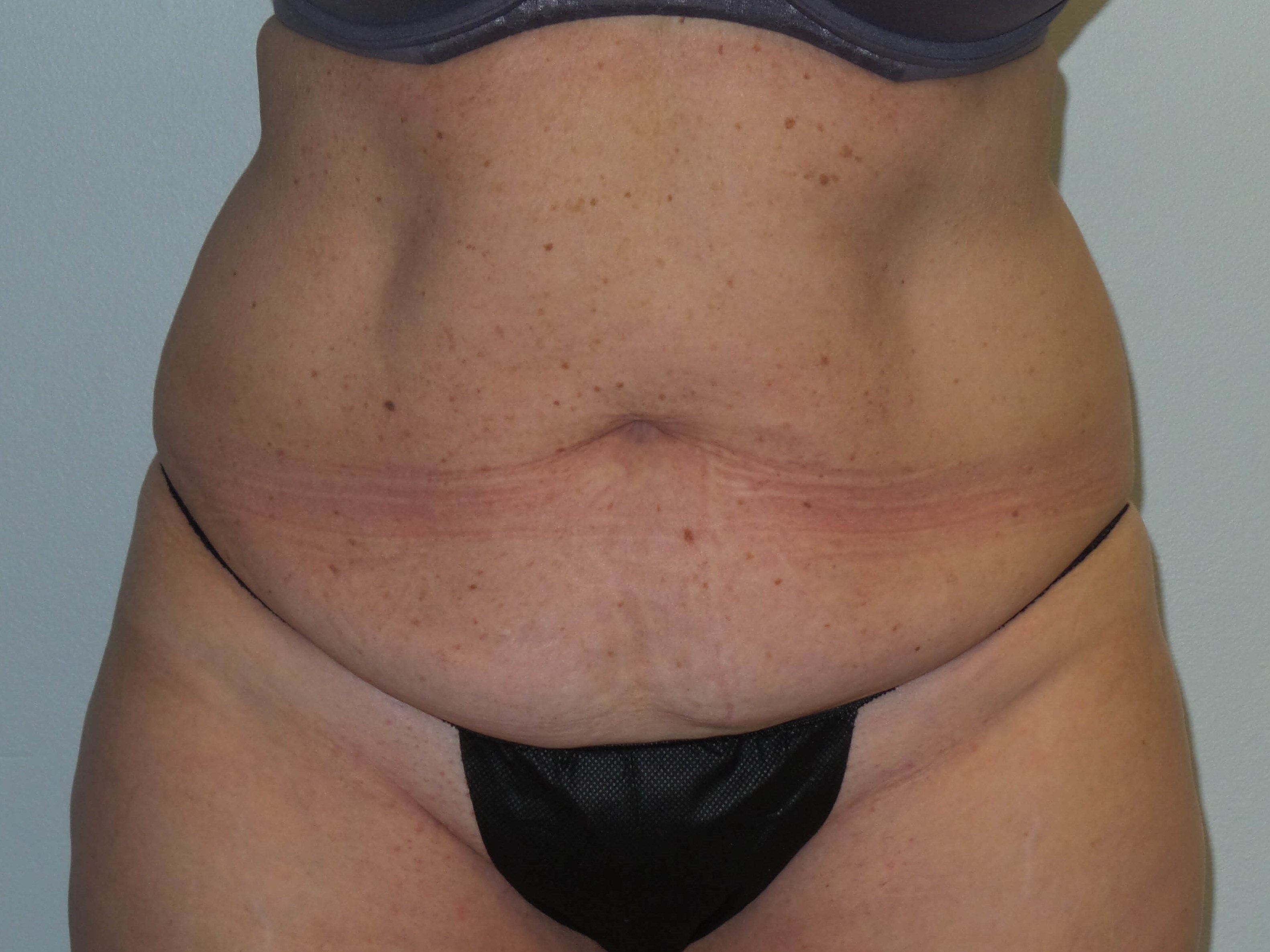 Woman Has Tummy Tuck Lipo Before