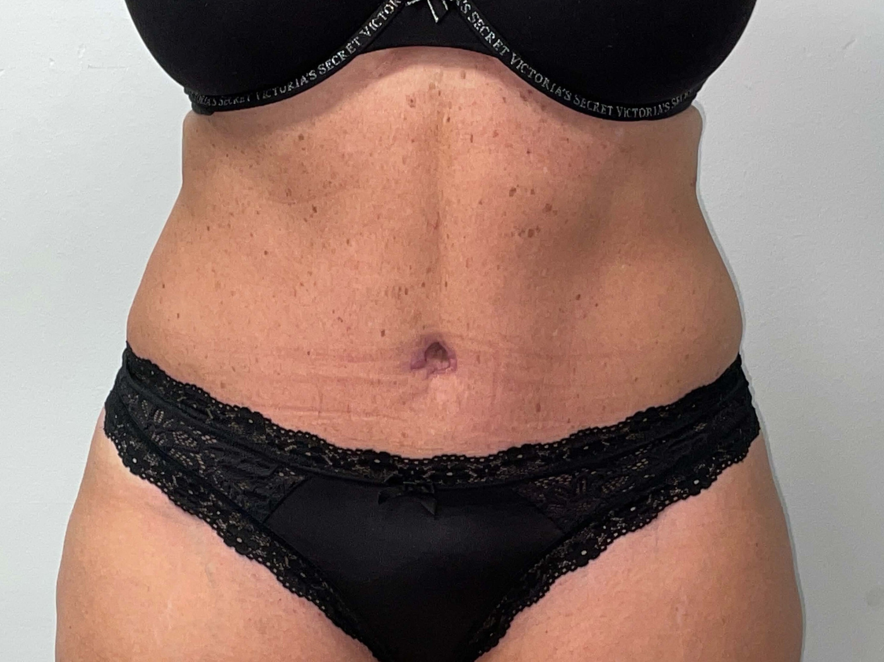 Woman Has Tummy Tuck Lipo After