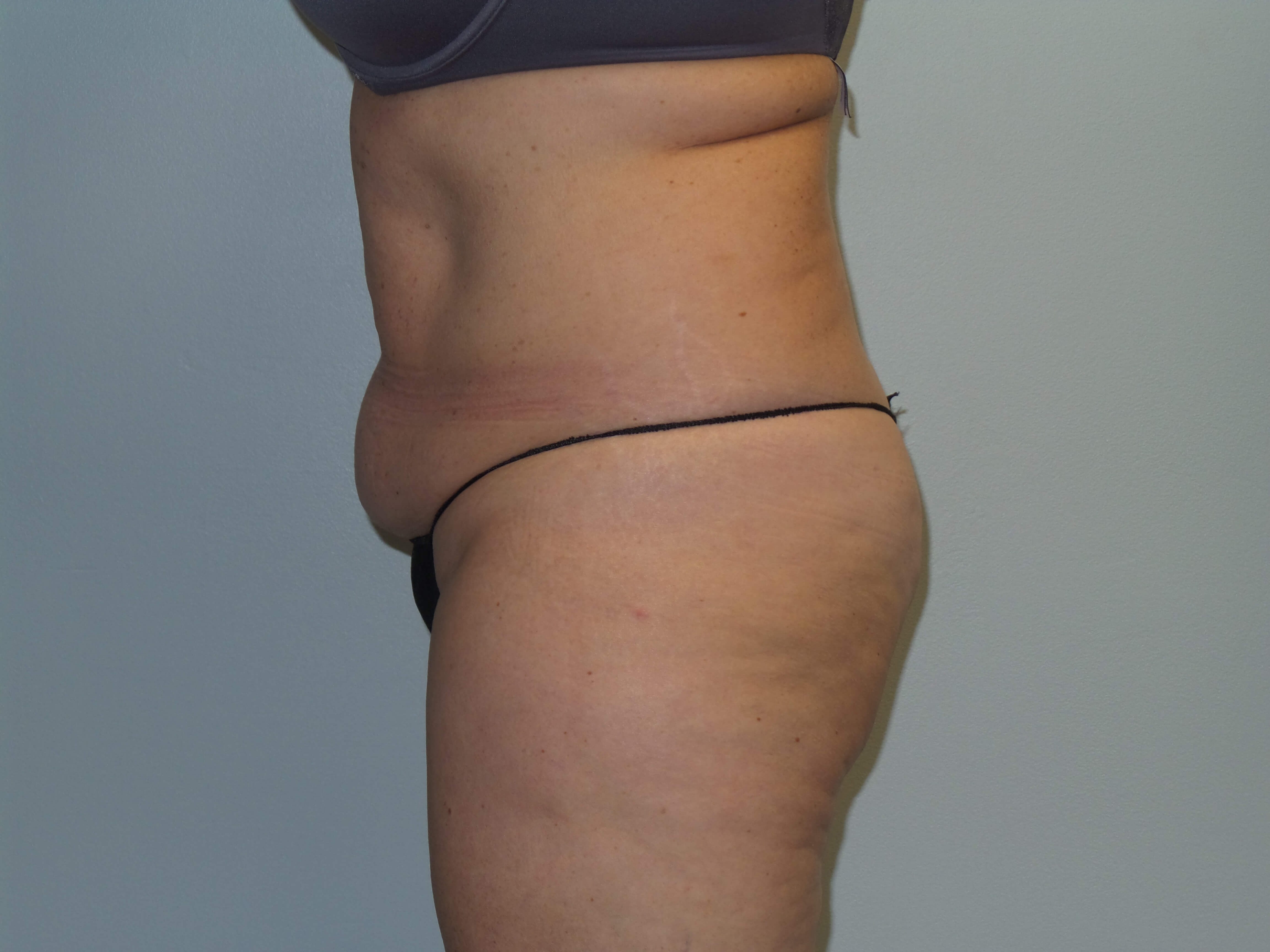 Woman Has Tummy Tuck Lipo Before