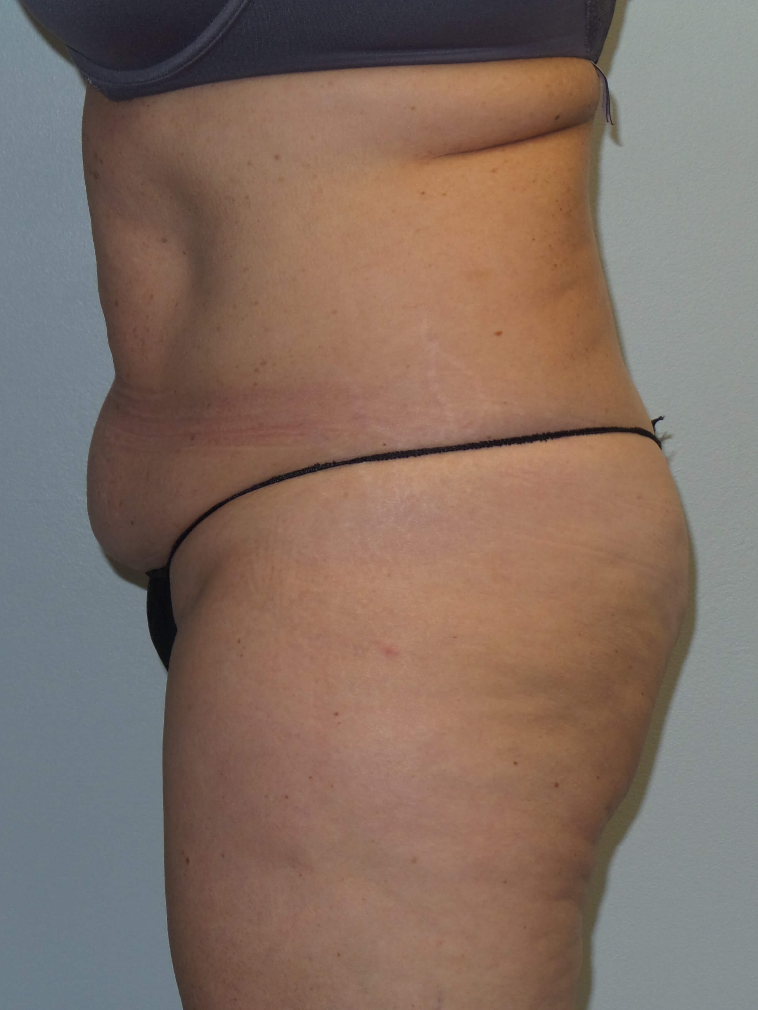 Woman Has Tummy Tuck Lipo Before