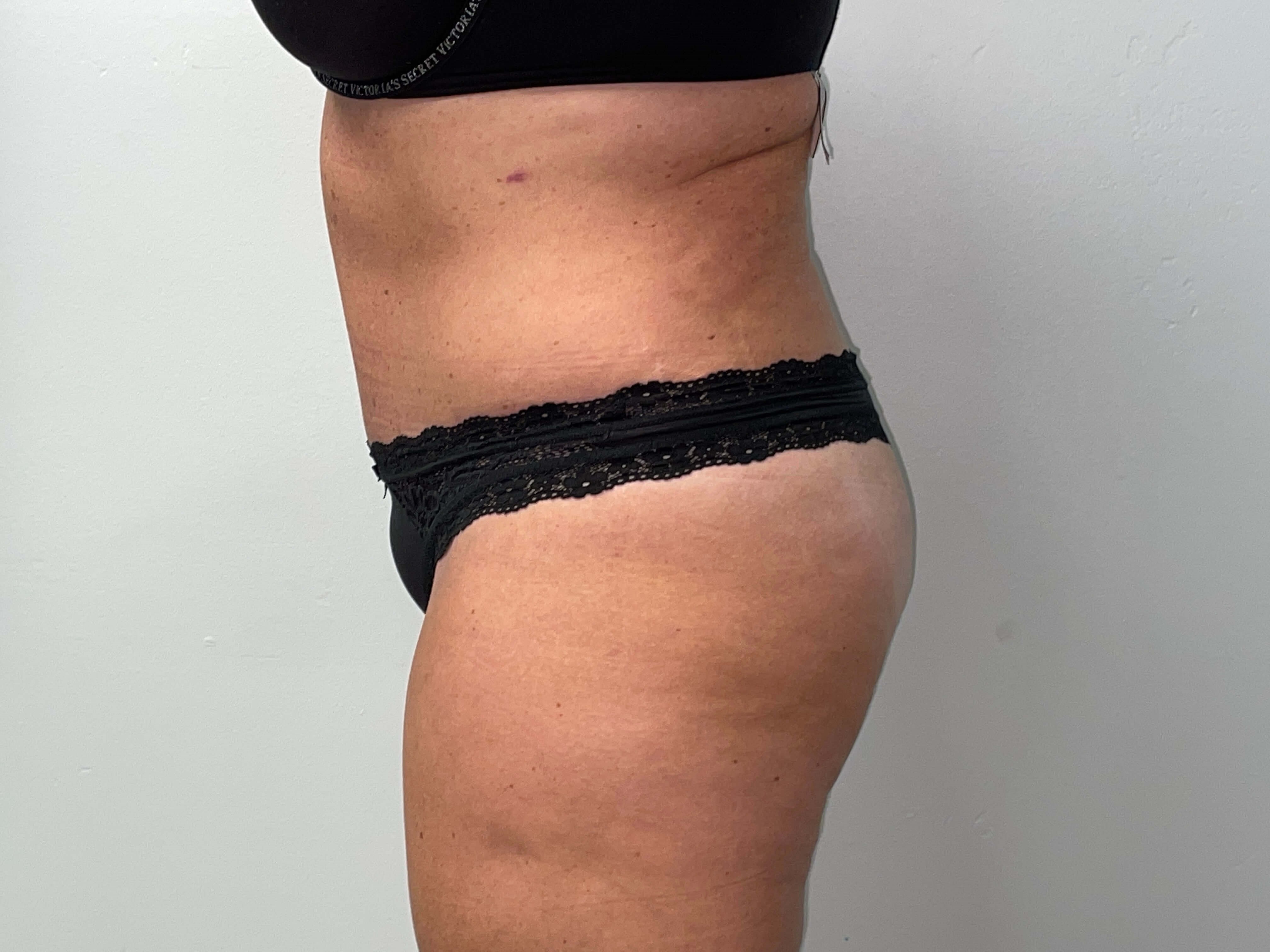 Woman Has Tummy Tuck Lipo After