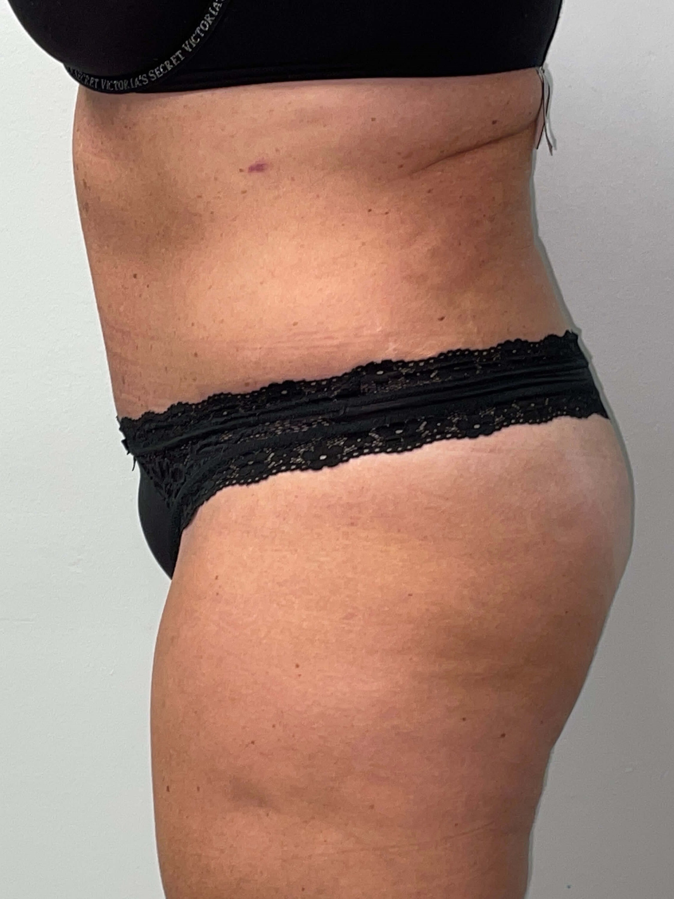 Woman Has Tummy Tuck Lipo After