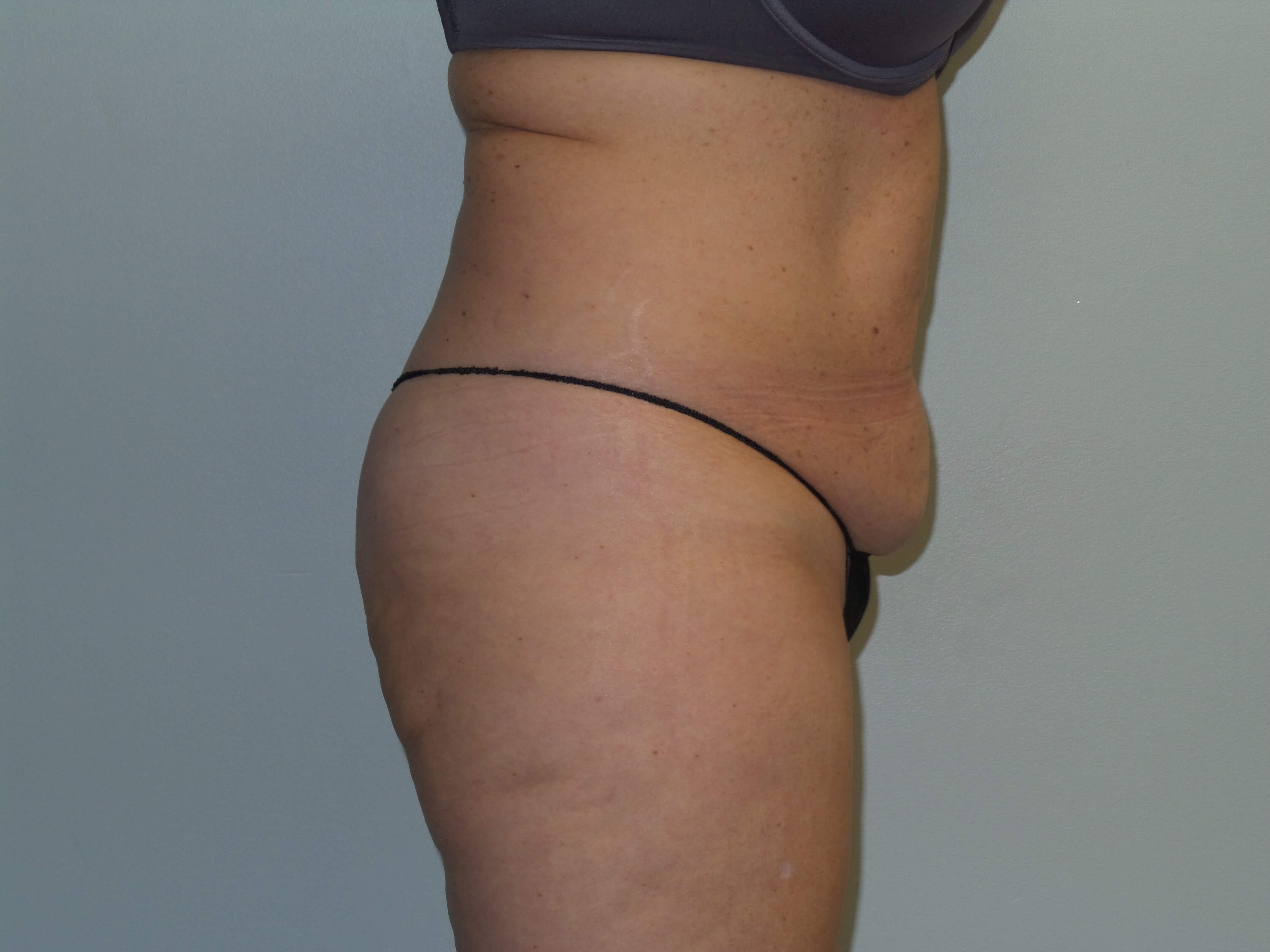 Woman Has Tummy Tuck Lipo Before