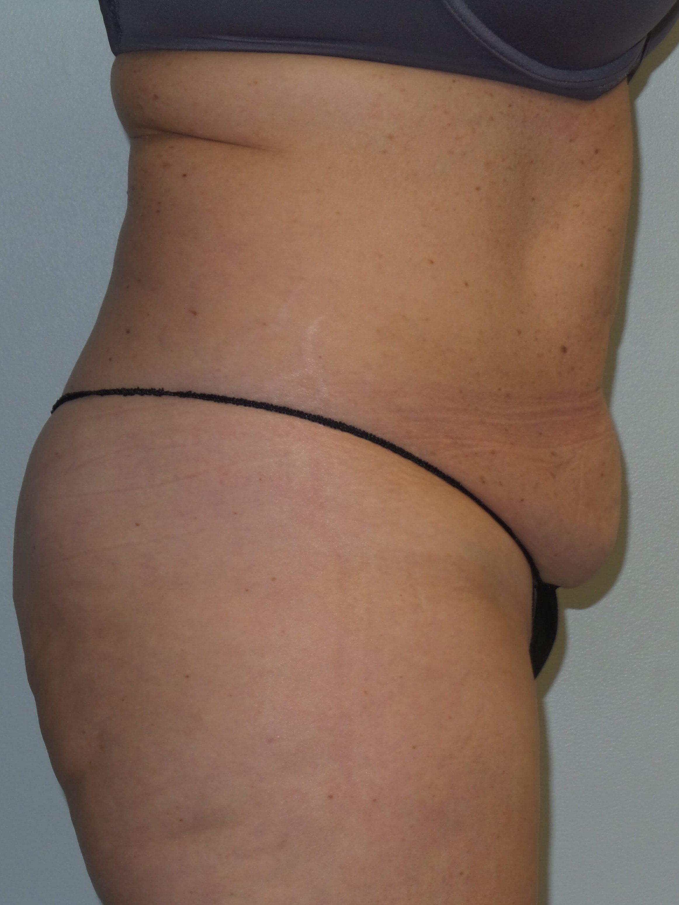Woman Has Tummy Tuck Lipo Before