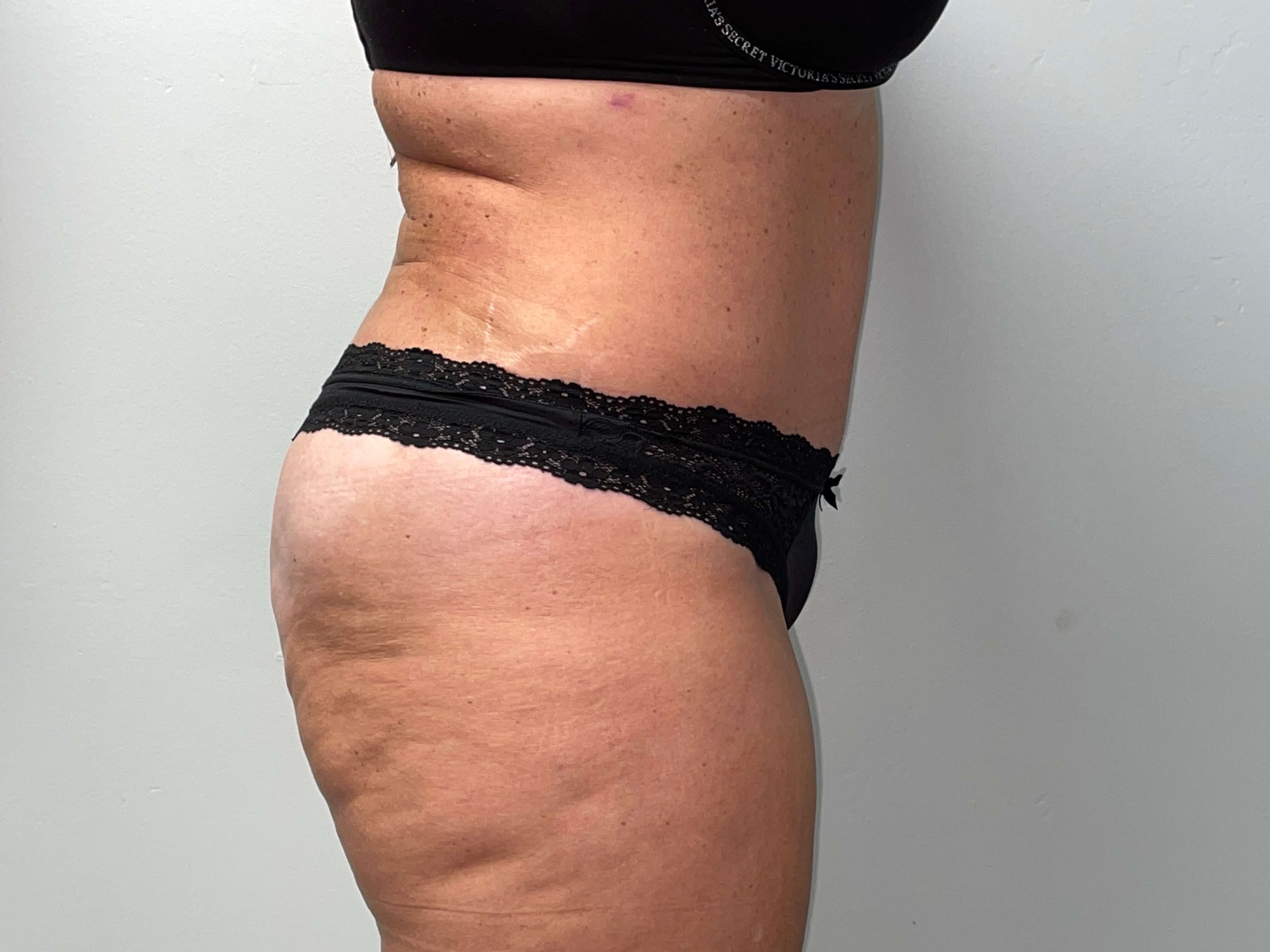 Woman Has Tummy Tuck Lipo After