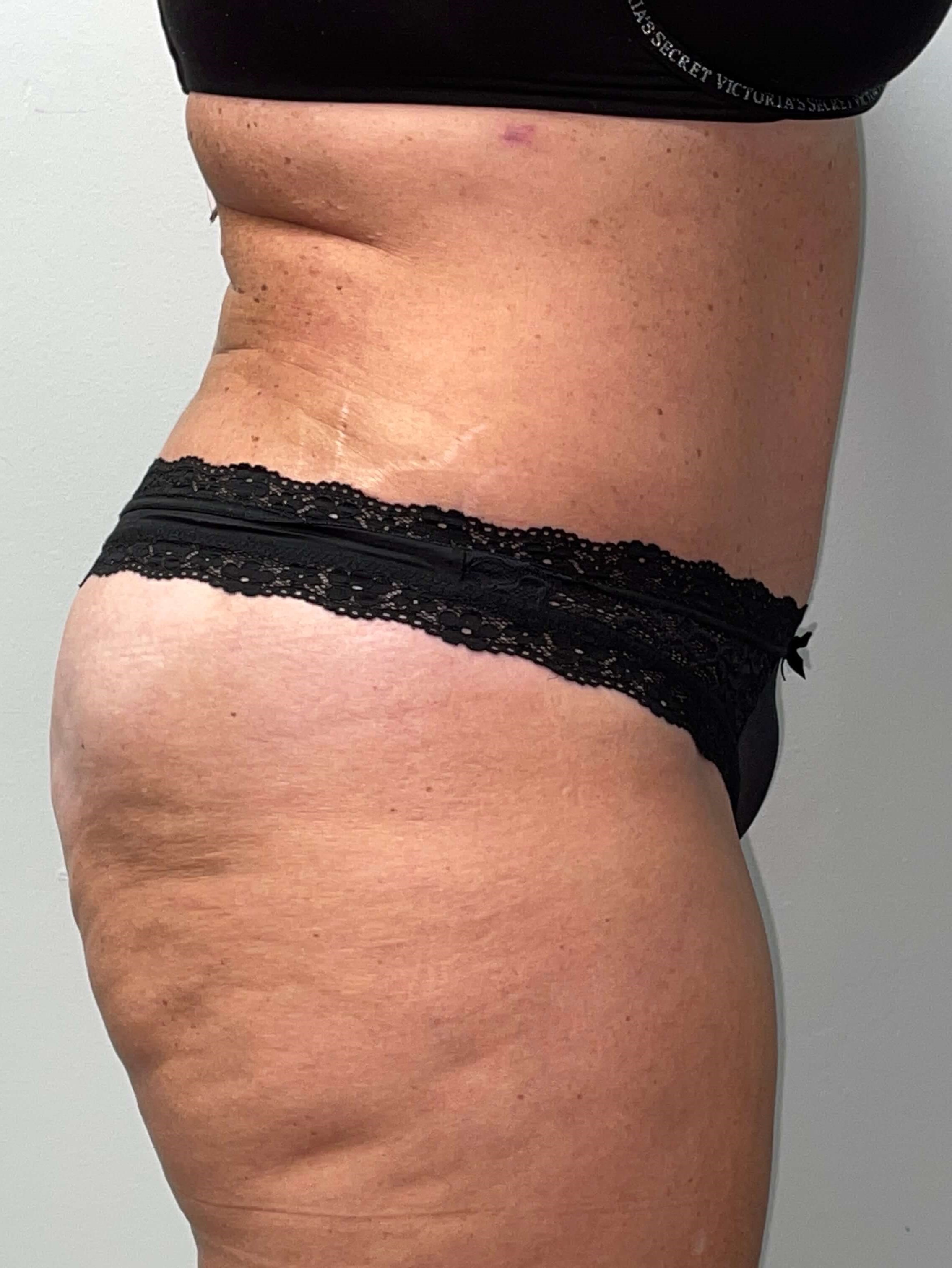 Woman Has Tummy Tuck Lipo After