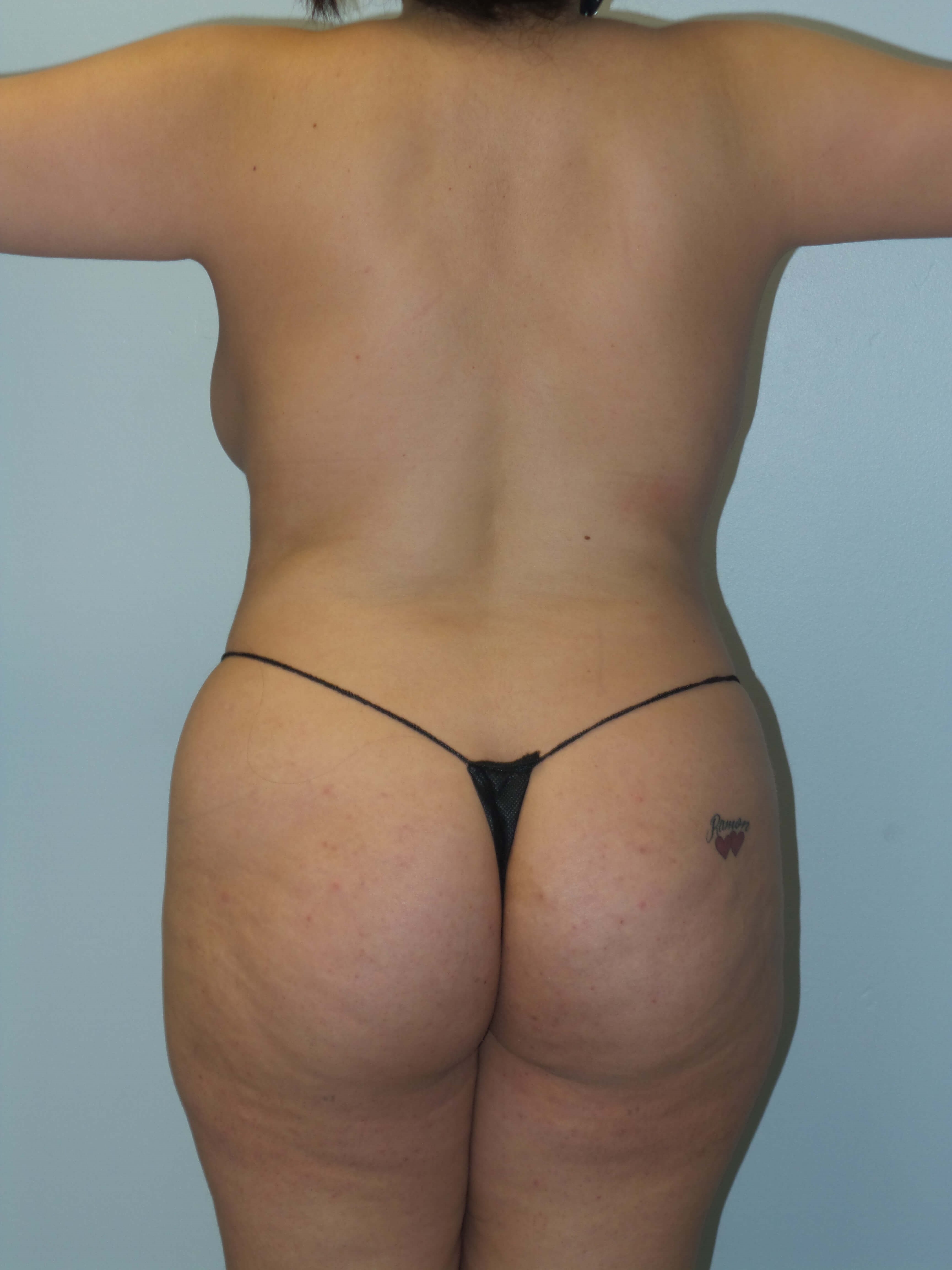 Woman has BBL Butt Lift Before