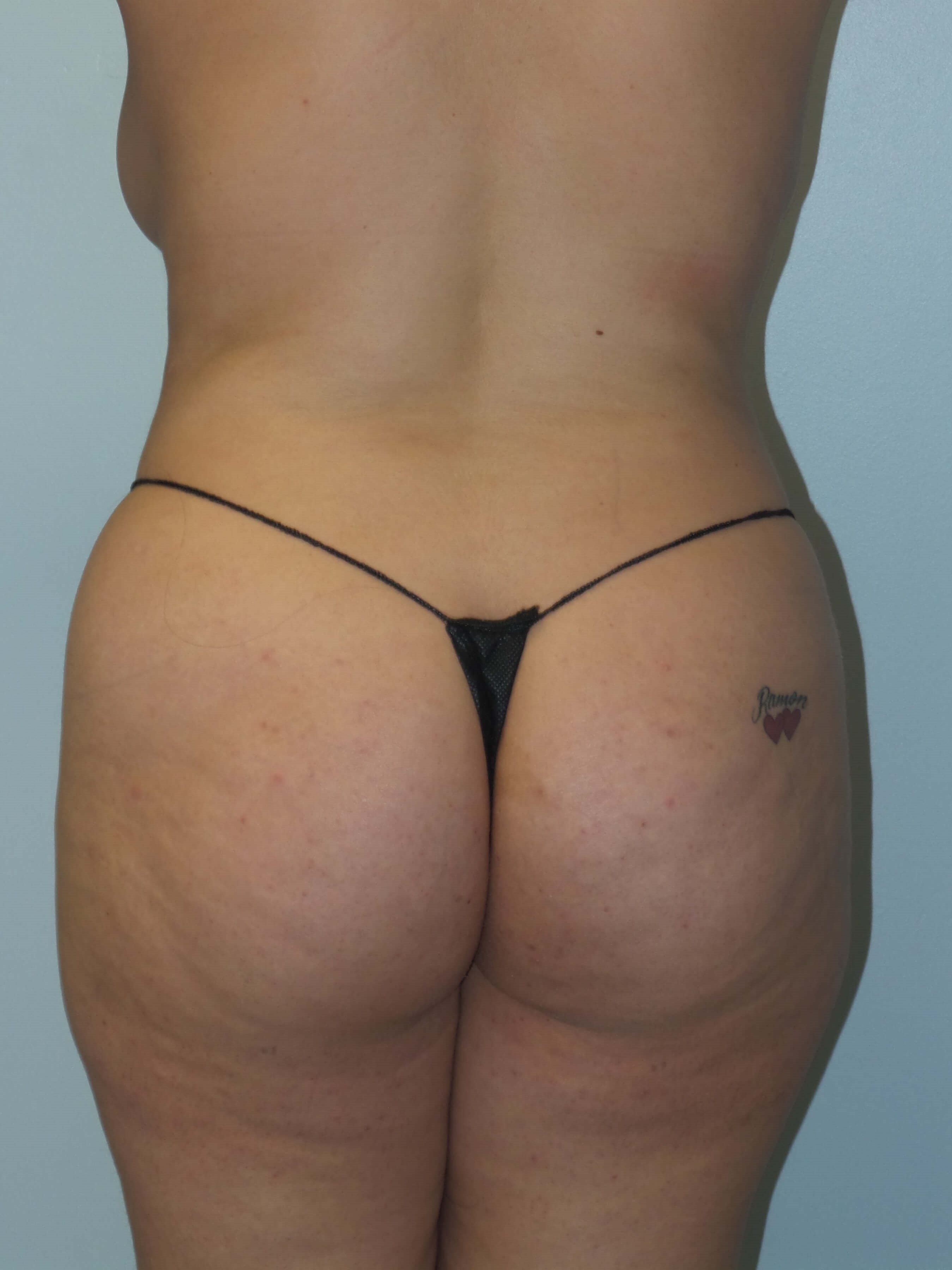 Woman has BBL Butt Lift Before