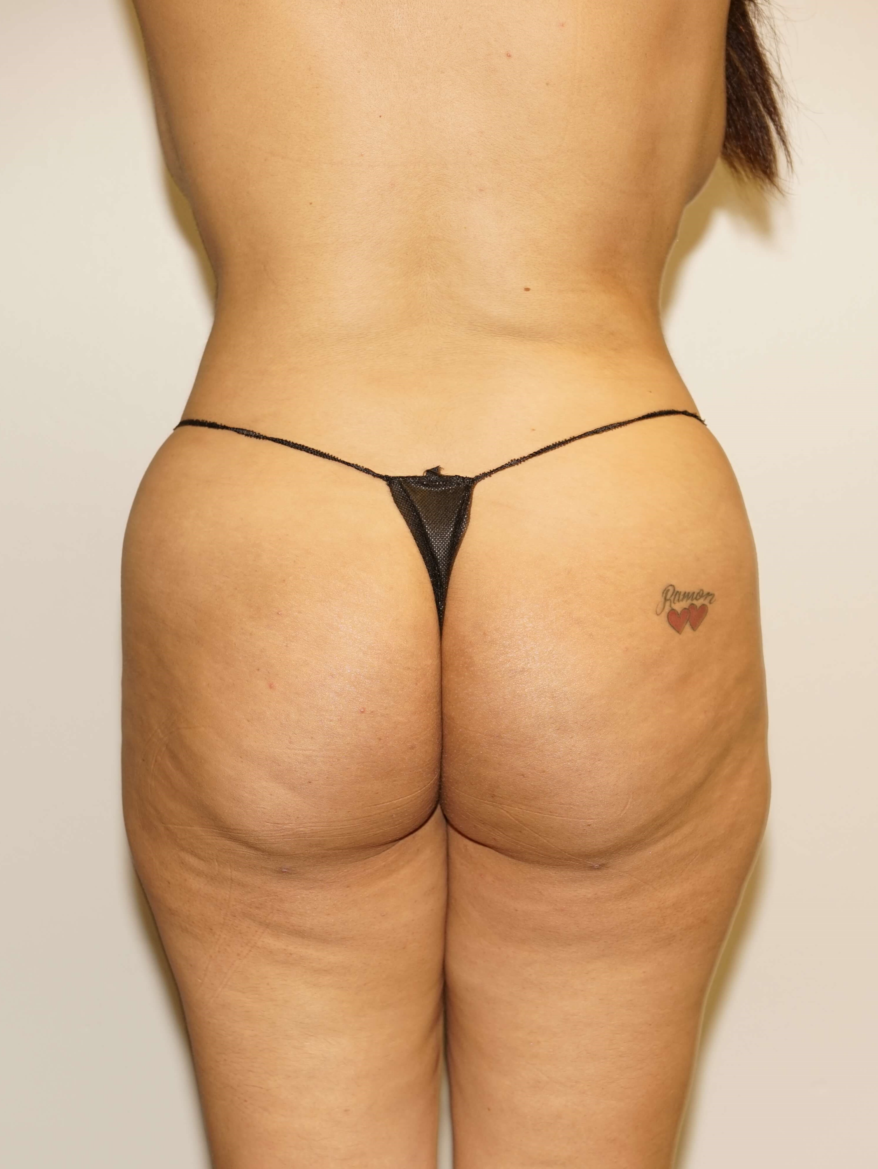 Woman has BBL Butt Lift After