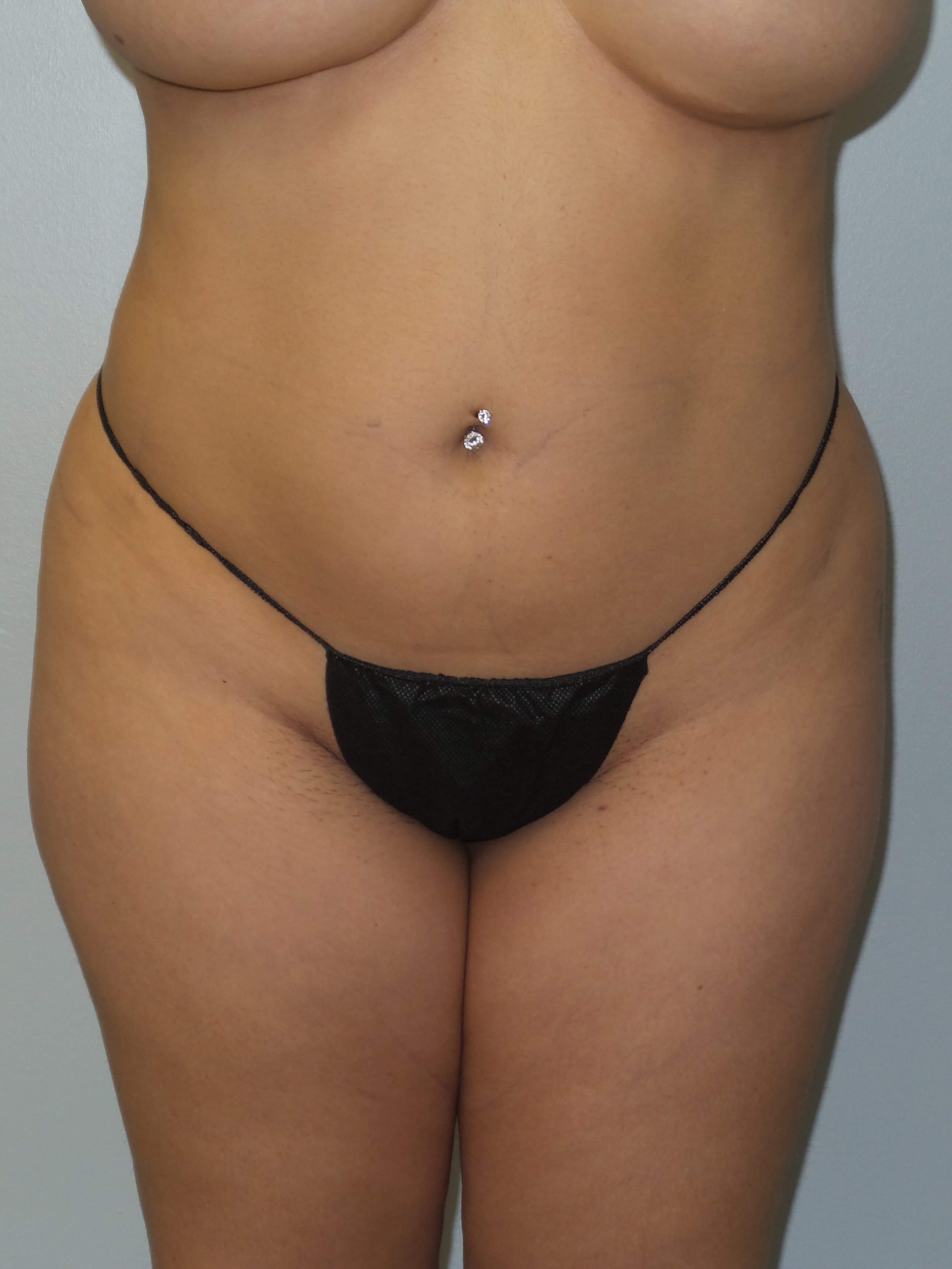 Woman has BBL Butt Lift Before