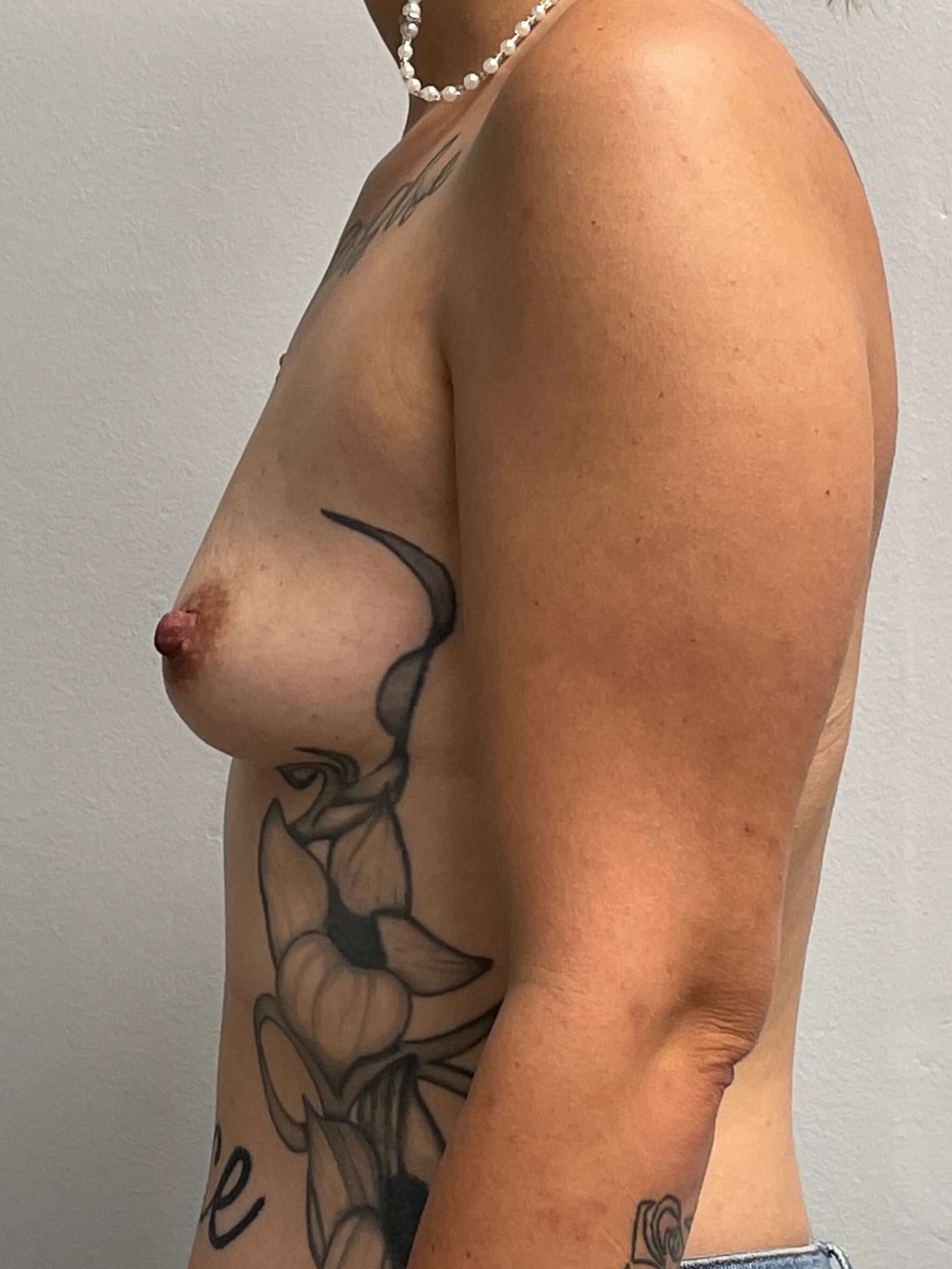Westlake Woman Has Breast Aug Before