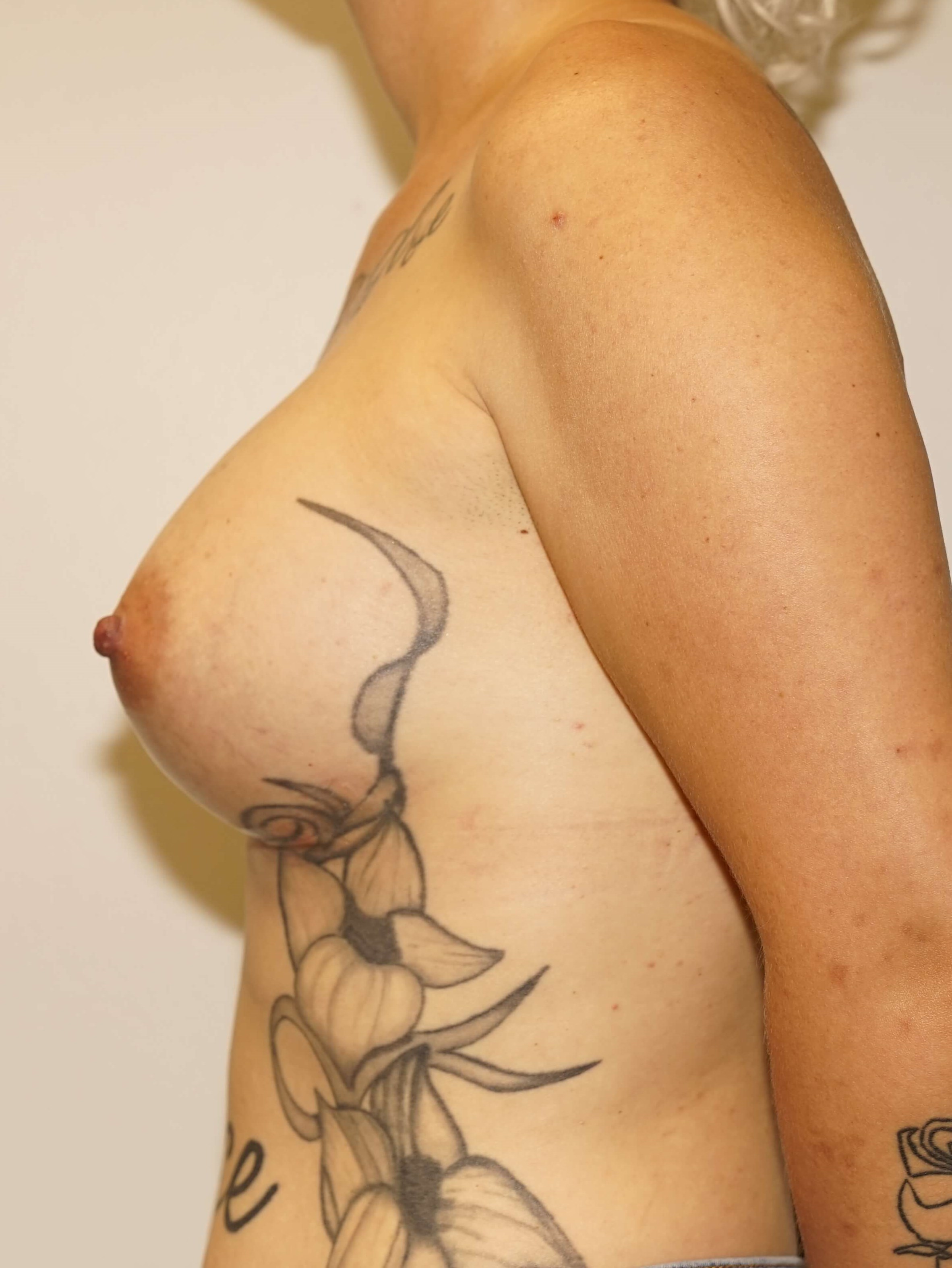 Westlake Woman Has Breast Aug After