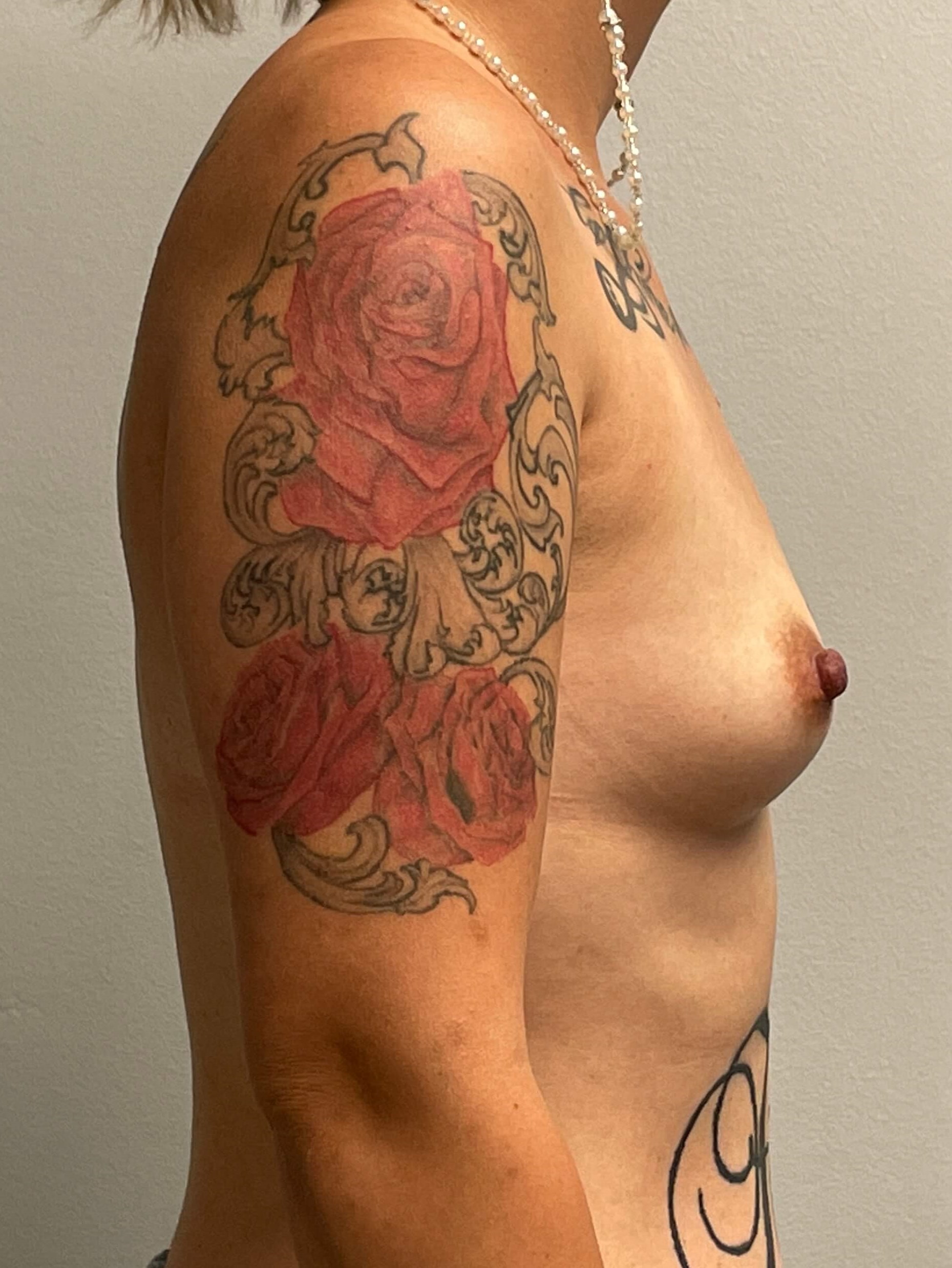 Westlake Woman Has Breast Aug Before