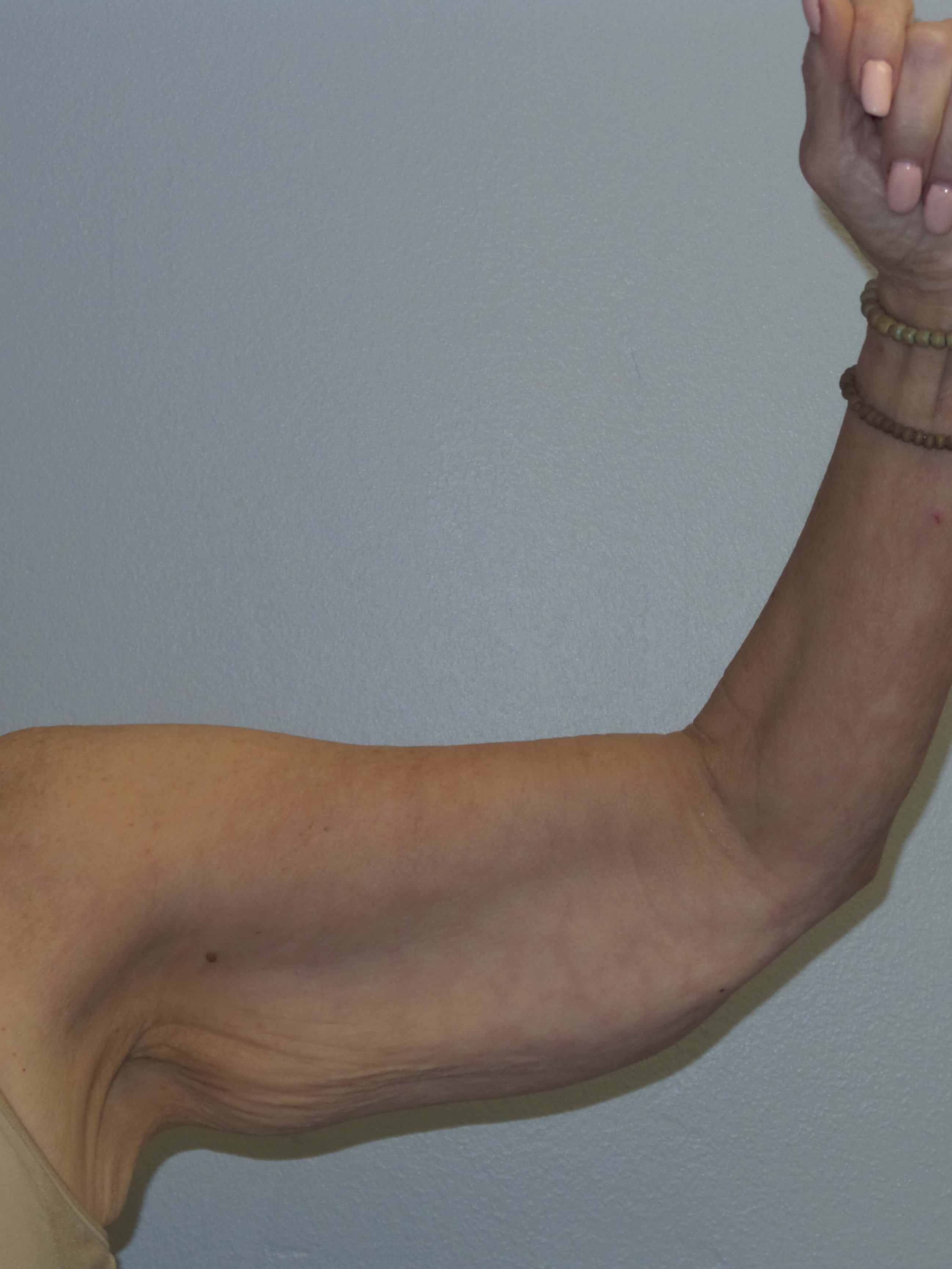Woman has Brachioplasty Before