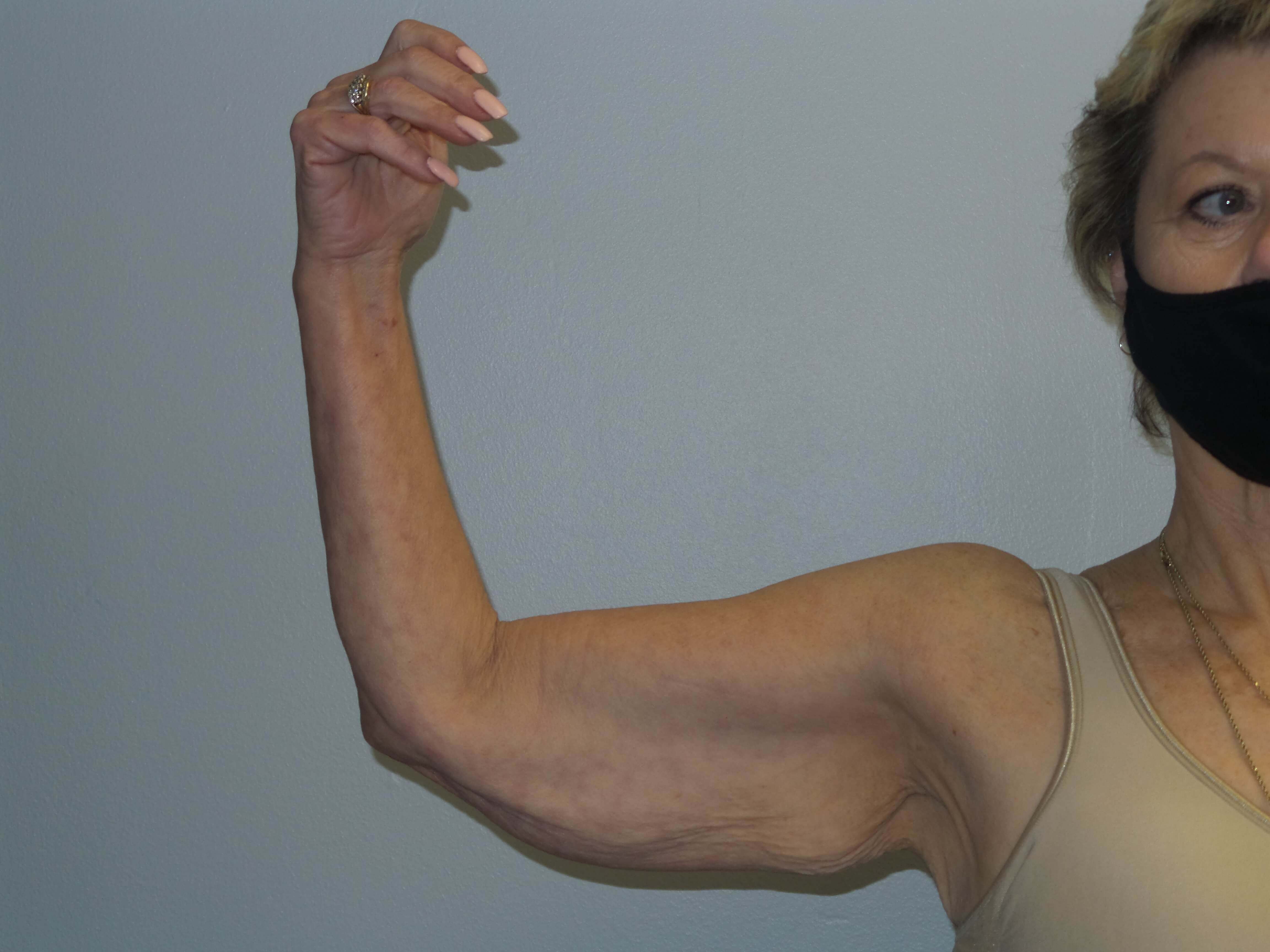 Woman has Brachioplasty Before