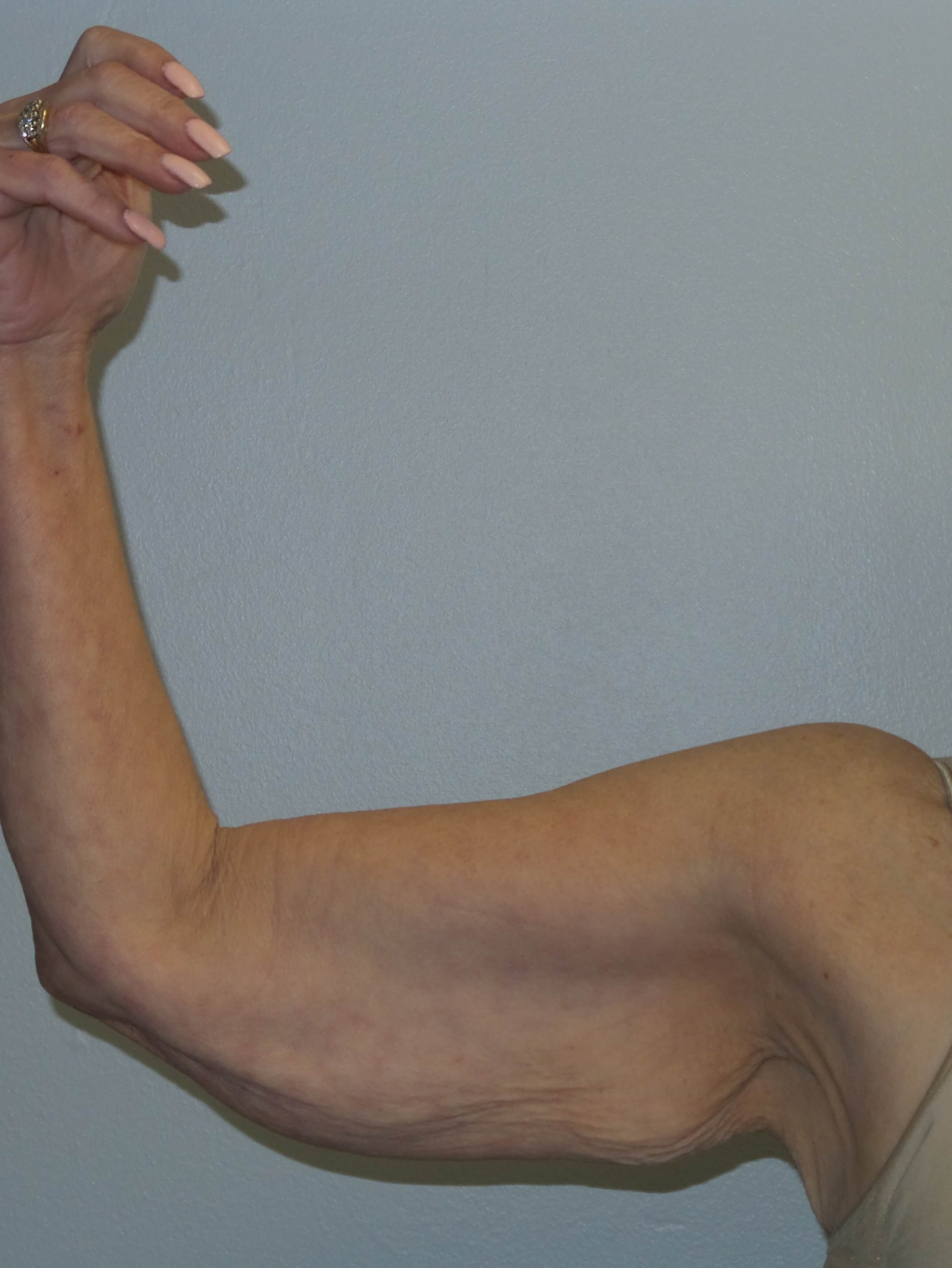 Woman has Brachioplasty Before