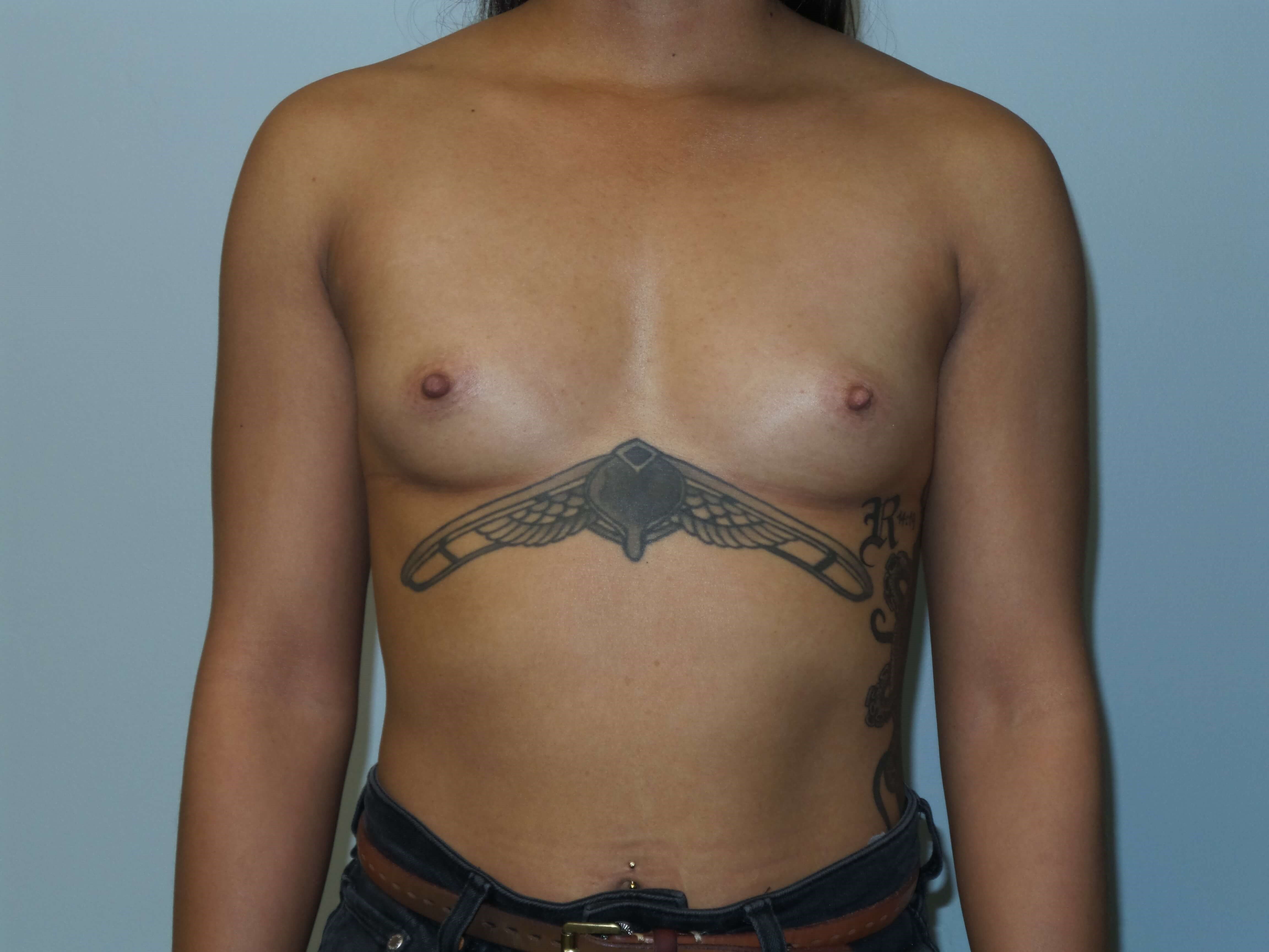 Westlake Woman Has Breast Aug Before