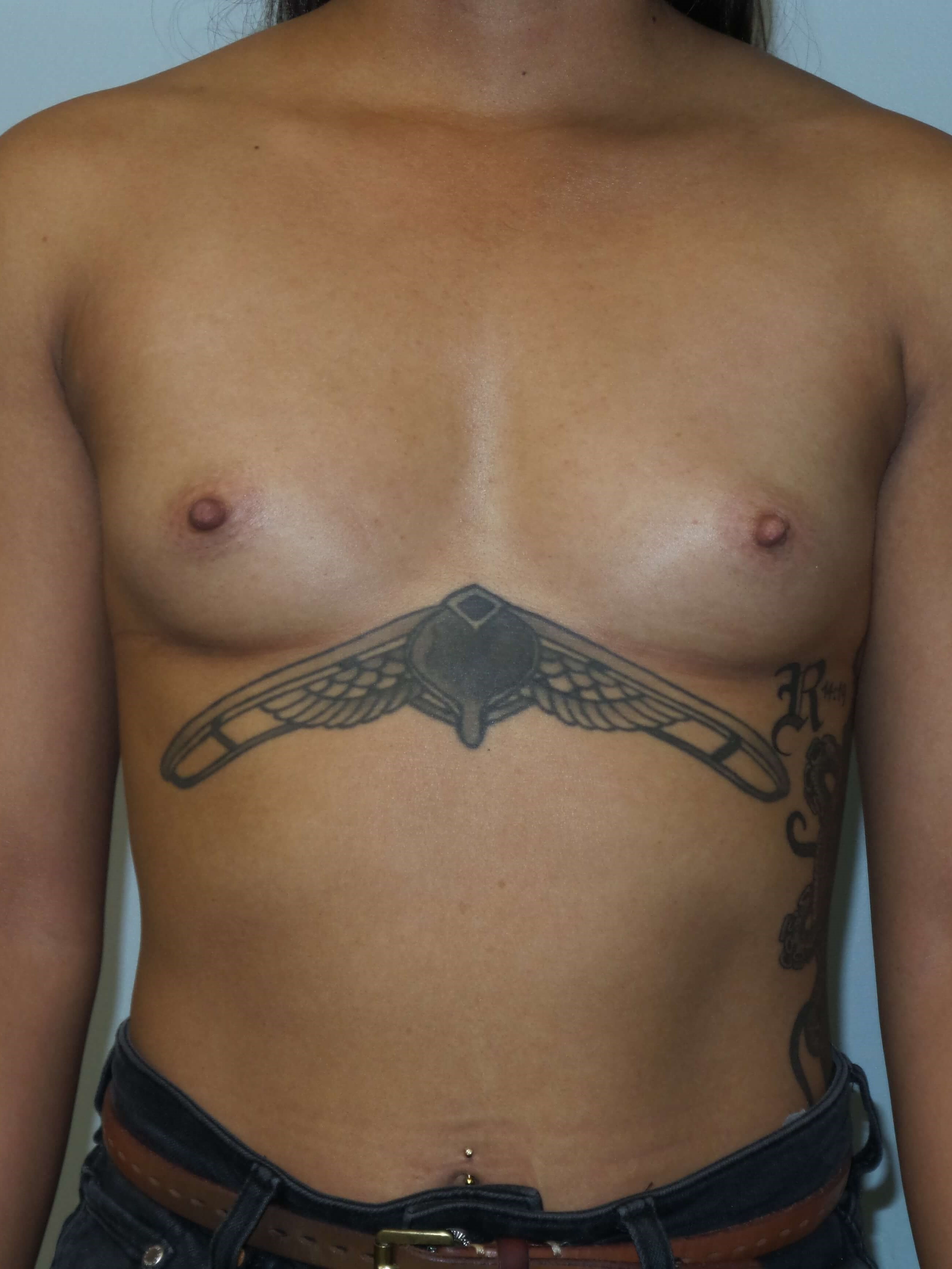 Westlake Woman Has Breast Aug Before