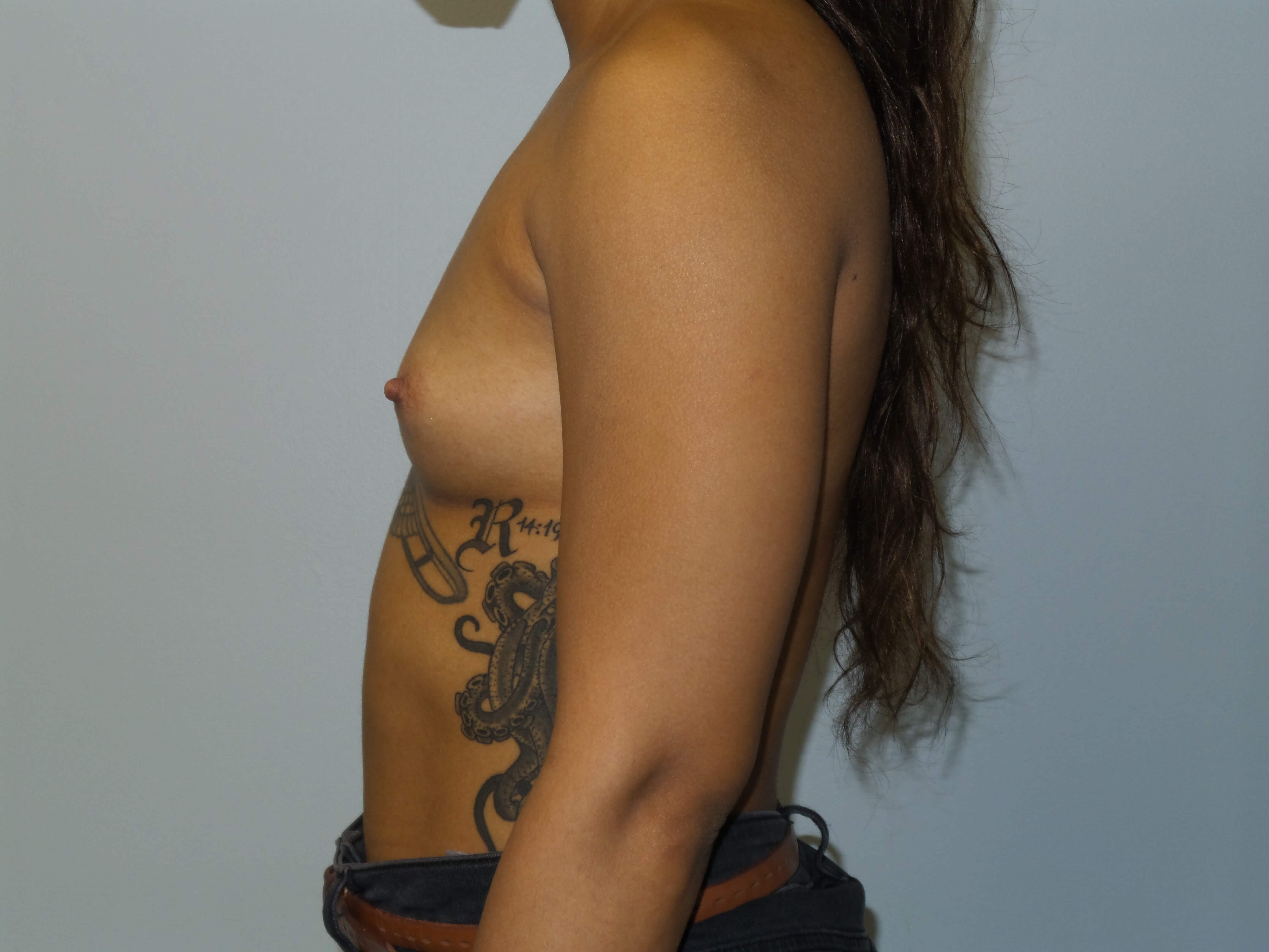 Westlake Woman Has Breast Aug Before