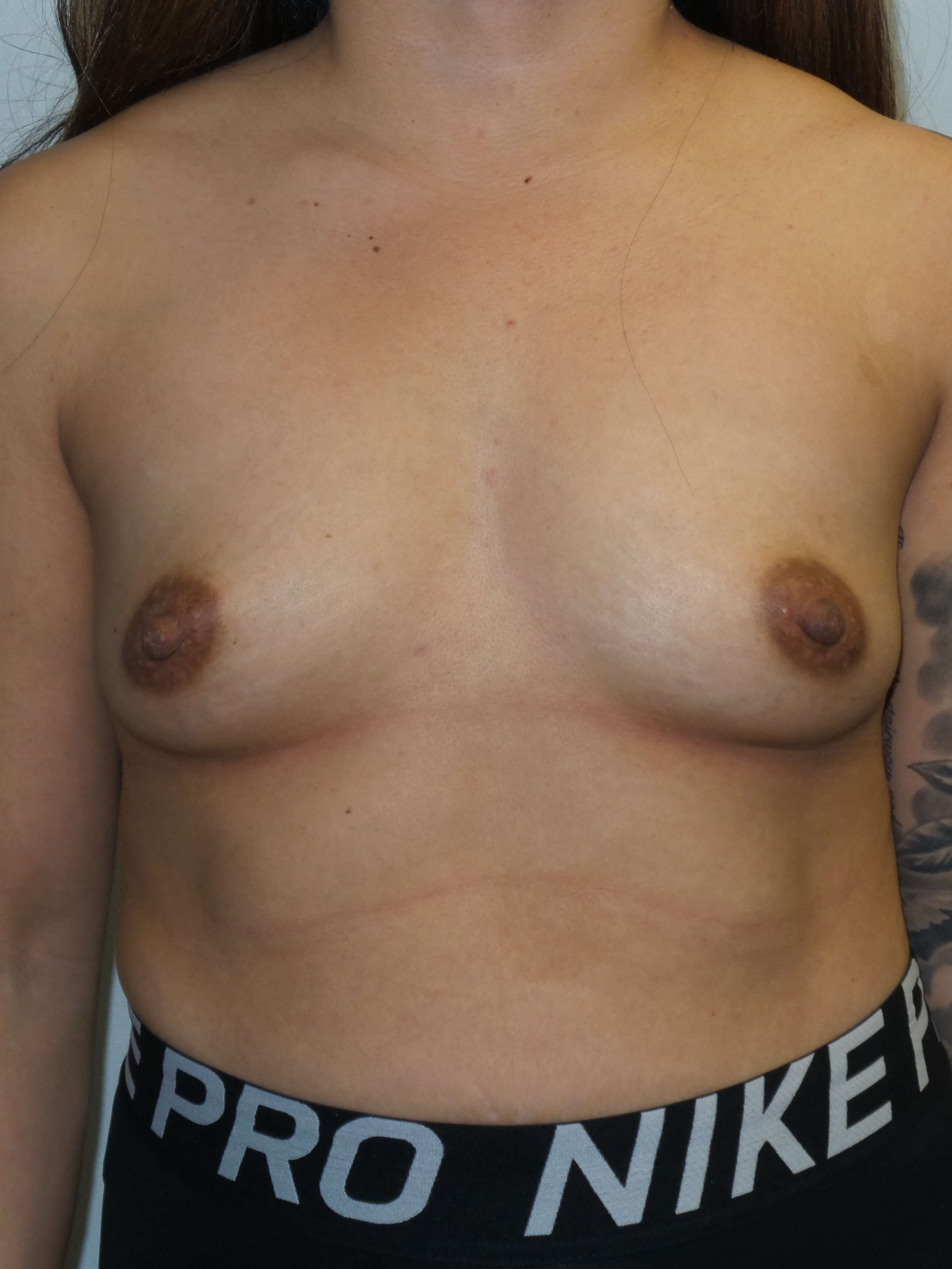 Westlake Woman Has Breast Aug Before