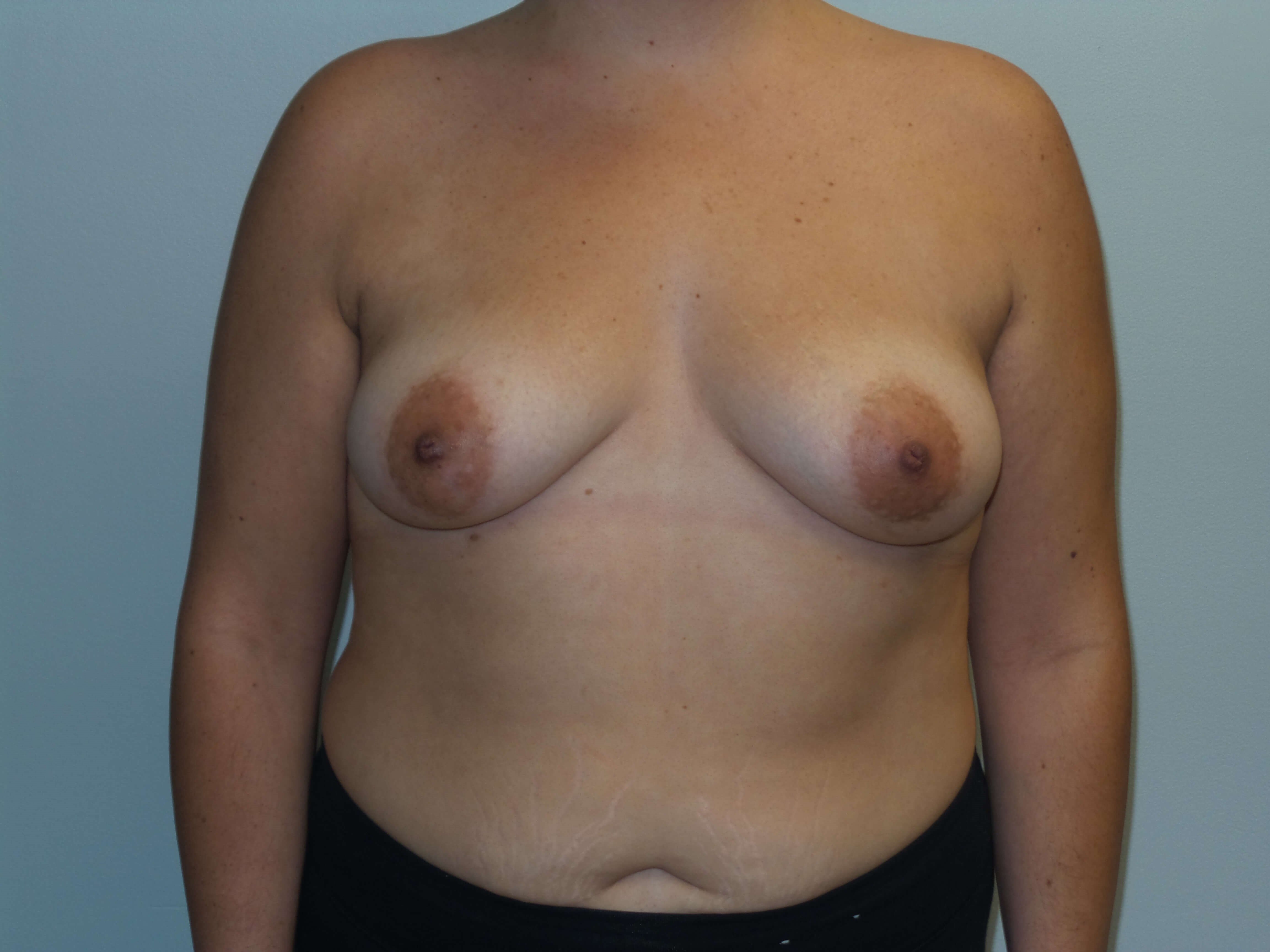 Westlake Woman Has Breast Aug Before