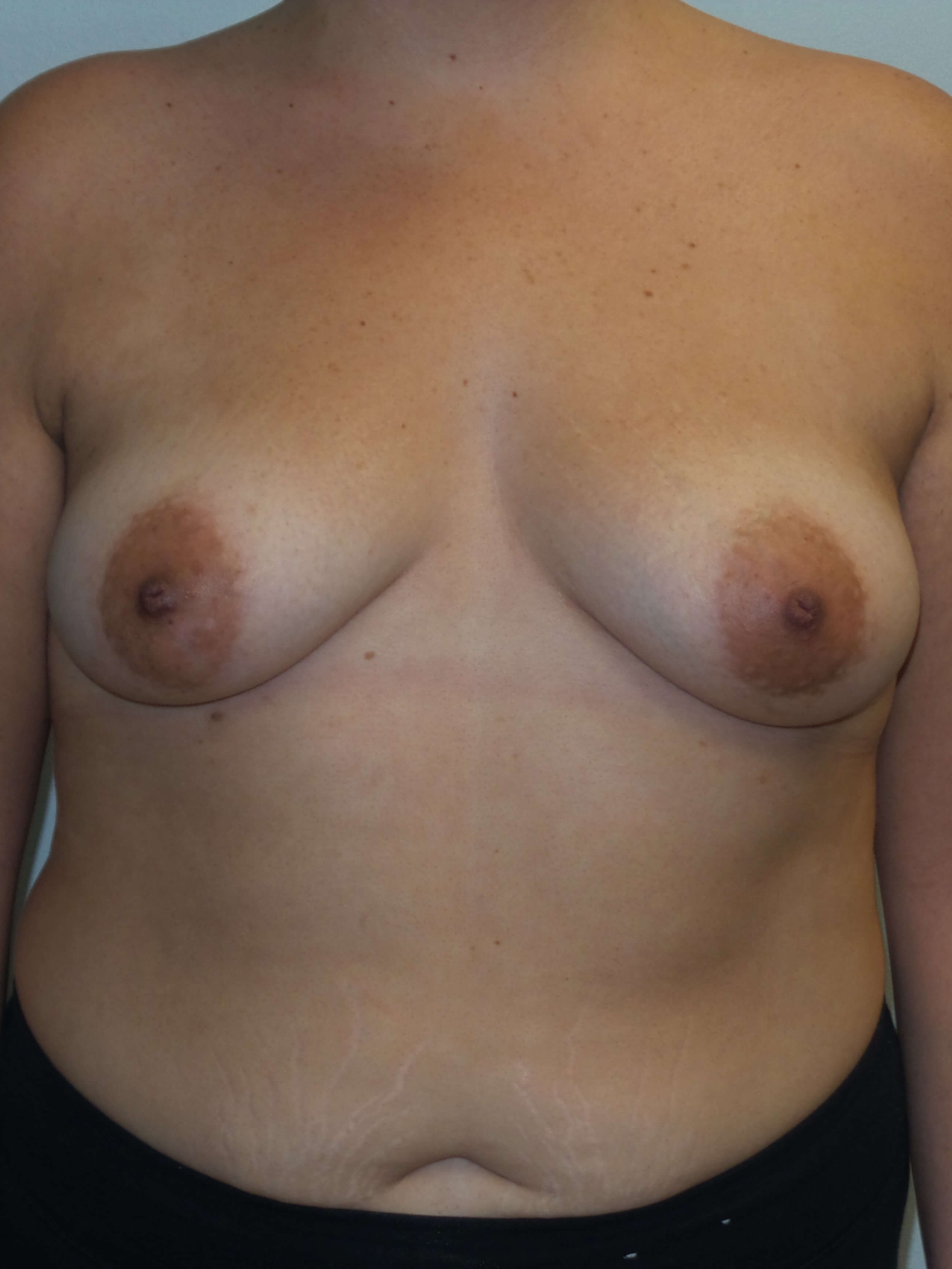 Westlake Woman Has Breast Aug Before