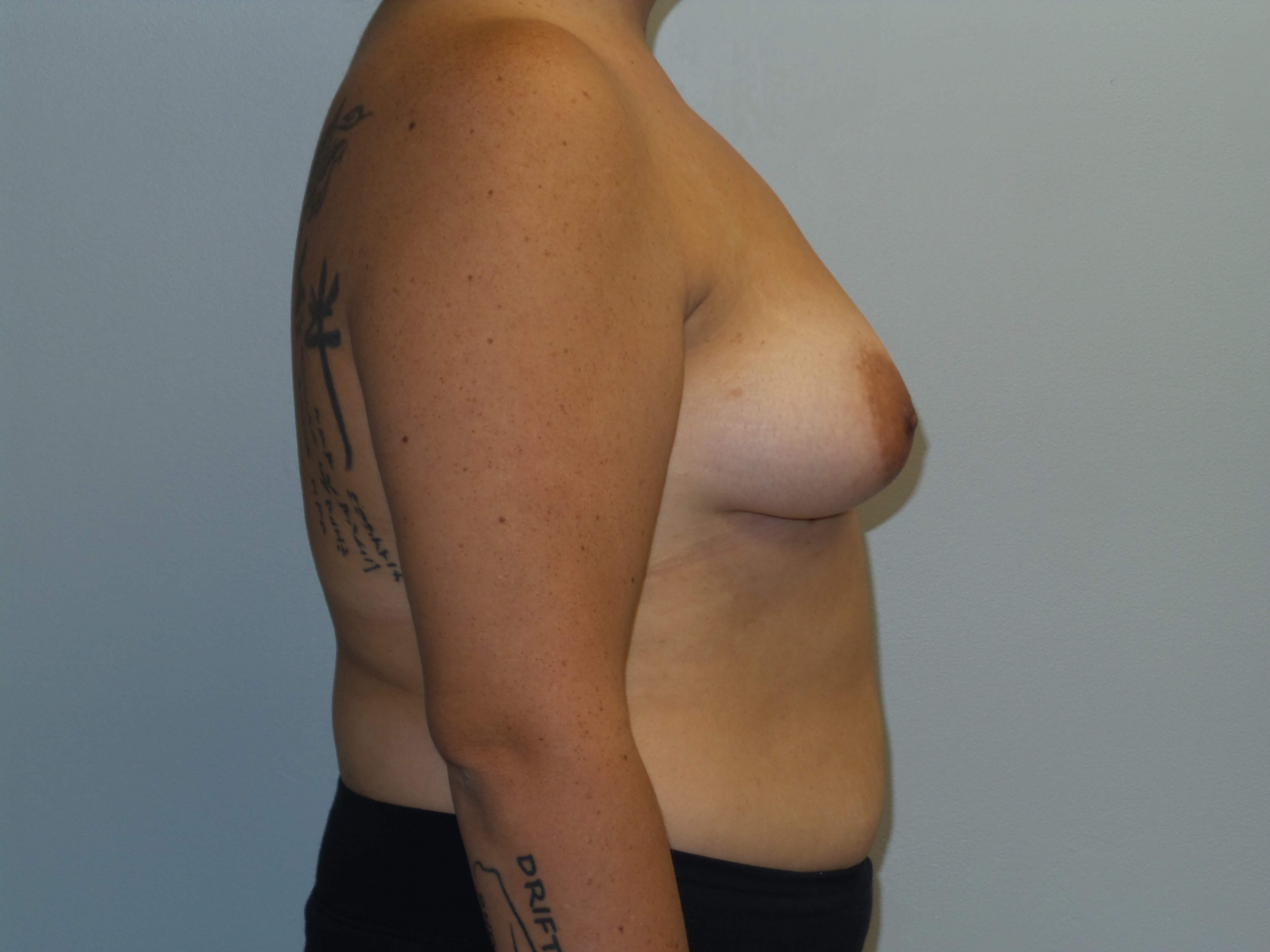 Westlake Woman Has Breast Aug Before