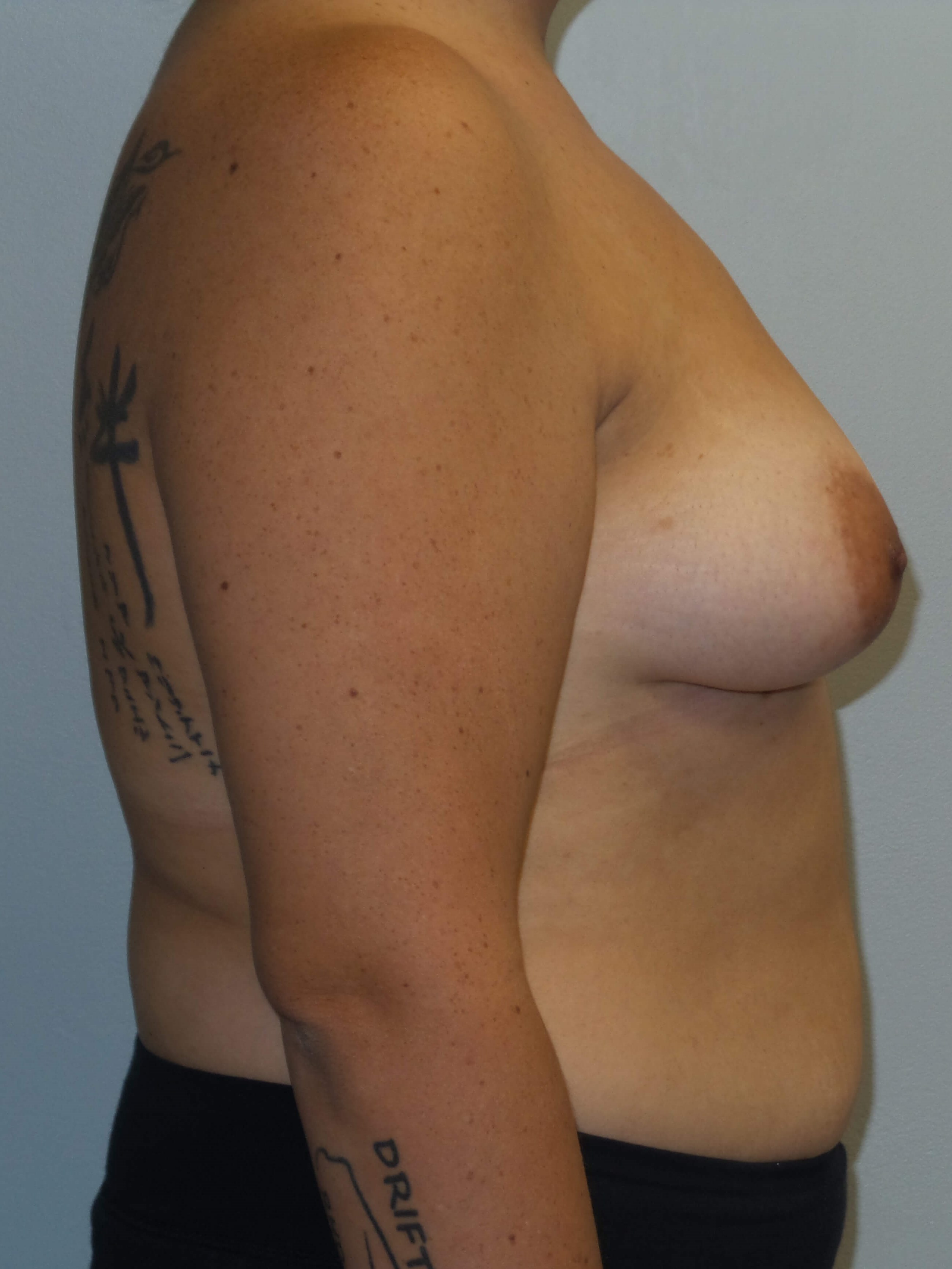 Westlake Woman Has Breast Aug Before