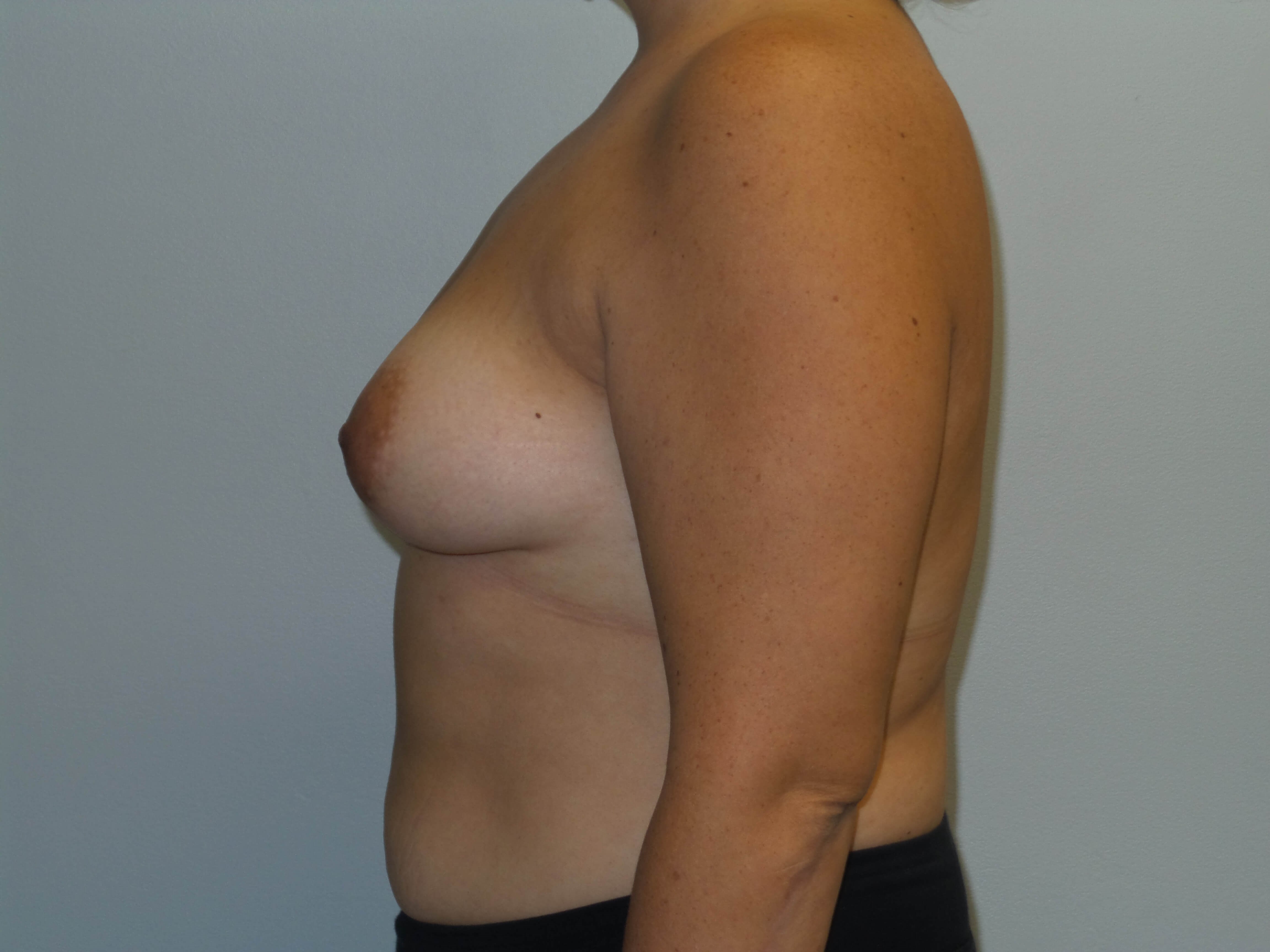 Westlake Woman Has Breast Aug Before